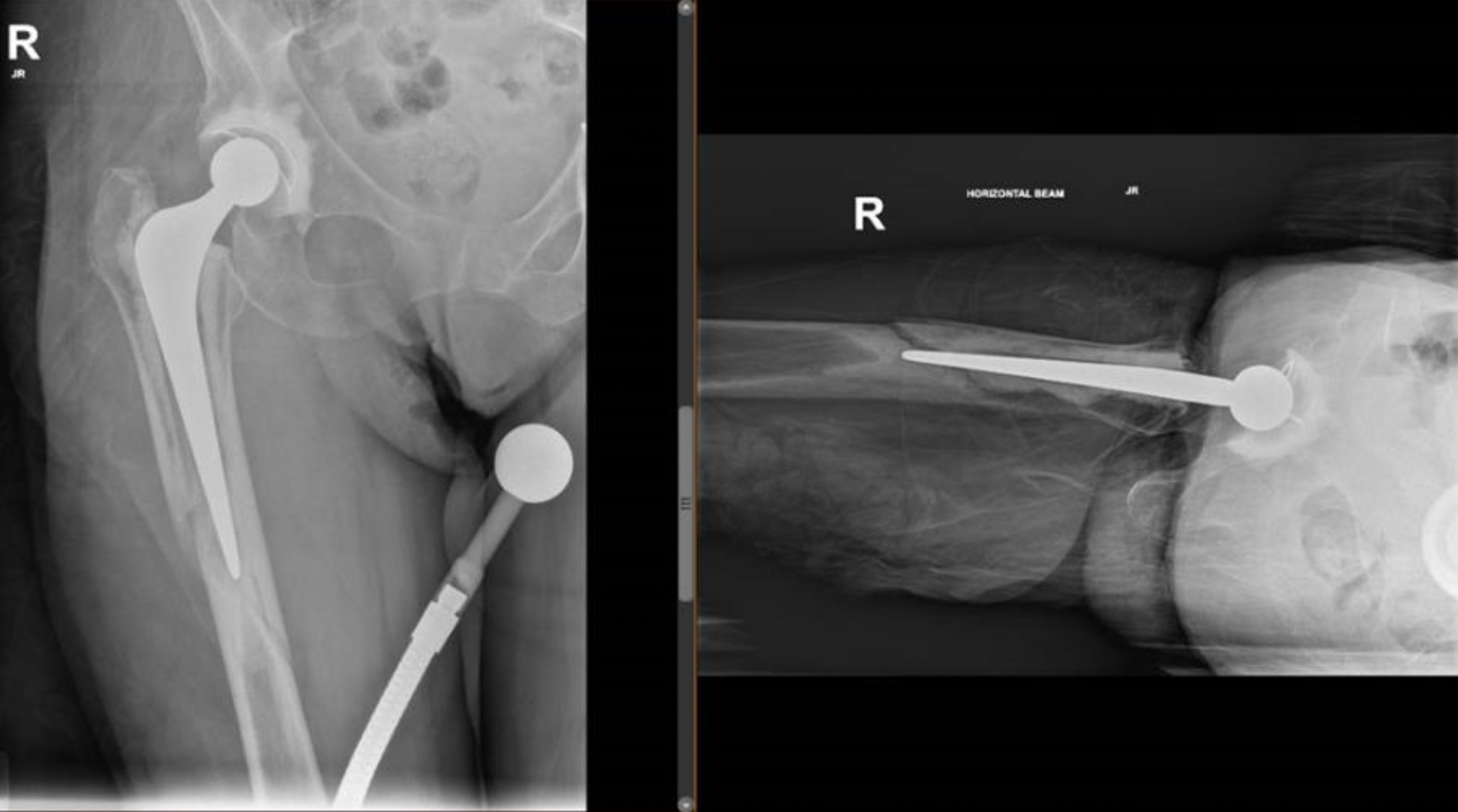 Fig. 1 
            Anteroposterior and lateral radiographs of a Vancouver 2B fracture around a cemented, taper-slip stem, with well-fixed bone-cement interface, used for the hypothetical clinical case.
          