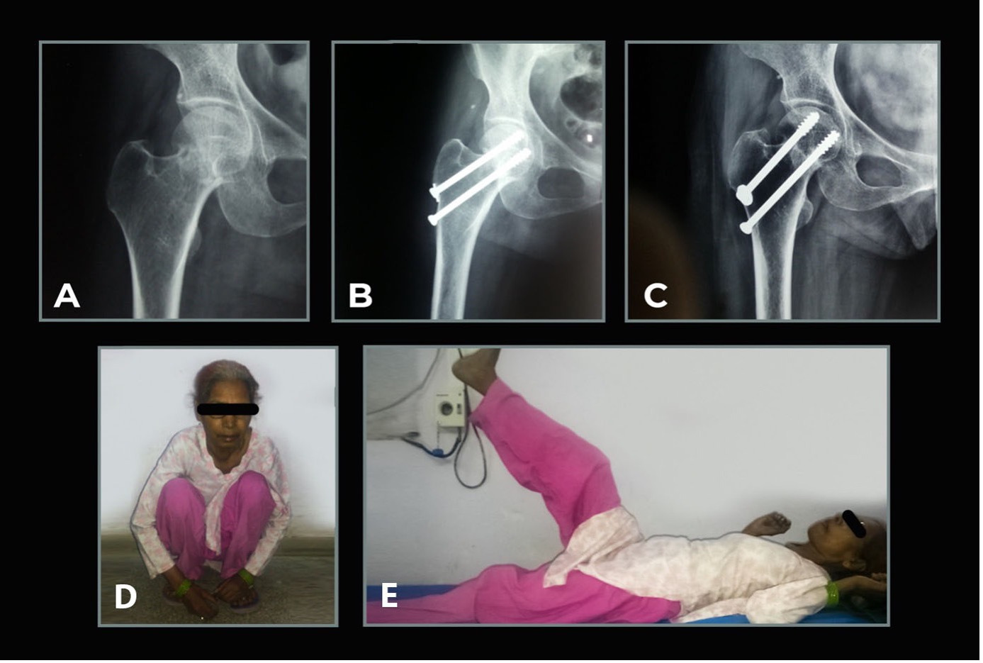 Fig. 1 
            Clinical case of cannulated compression screw (CCS) technique. a) Preoperative AP radiograph showing displaced Garden type 3 fracture. b) Postoperative radiograph showing closed reduction and internal fixation with CCS. c) Two-year radiograph shows healing of fracture. Femoral head shows no signs of osteonecrosis. d) and e) Patient capabilities at two-year follow-up (full squatting and straight leg raise).
          