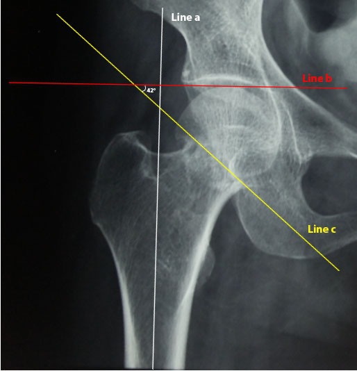 Fig. 2 
            Simulated intraoperative planning for valgus hip osteotomy and operative fixation. Fluoroscopic image of right hip fracture showing calculation of modified Pauwel’s angle. First, a longitudinal axis of the femur is identified (line a). Second, a line is made perpendicular to the longitudinal axis (line b) to the level of the superior edge of the femoral head. Third, a line is made along the subcapital fracture line (line c) to line b. Pauwels angle is the acute angle subtended by line b and c. Fourth, the calculated correction angle (CCA) is Pauwel’s angle – 30°. In this example, Pauwel’s angle is 42°. The CCA is 12°. Thus, the wedge angle in the osteotomy is also 12°.
          