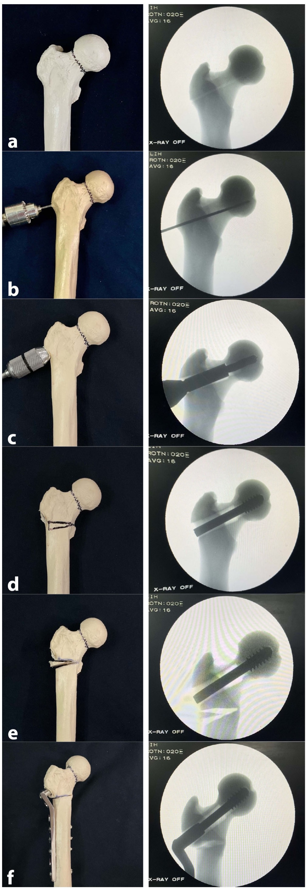Fig. 3 
            Step-wise demonstration of intraoperative technique of valgus hip osteotomy and operative fixation (saw bone model). a) The subcapital fracture is anatomically reduced. b) The pin insertion angle (PIA) is calculated. The PIA is 120° (dynamic hip screw (DHS) barrel angle) – calculated correction angle (CCA). This will allow the DHS plate to sit flush with the lateral femoral cortex after the osteotomy is made. c) A guidewire is placed into the femoral head at the PIA and then prepared for insertion of the lag screw using the DHS Triple Reamer. d) The lag screw is inserted to within 2 to 4 mm of the subchondral plate, confirmed in orthogonal views. e) A transverse osteotomy cut is made at the level of lesser trochanter (but not through the medial cortex). The second oblique cut is made to equal the CCA. We emphasize that the saw cuts do not violate the medial femoral cortex. f) The lateral plate is connected to the lag screw and the osteotomy is closed with an audible snap. Cortical transverse screws are placed in compression mode to compress the osteotomy site. Finally, a compression screw is placed in the lag screw to compress the neck fracture.
          