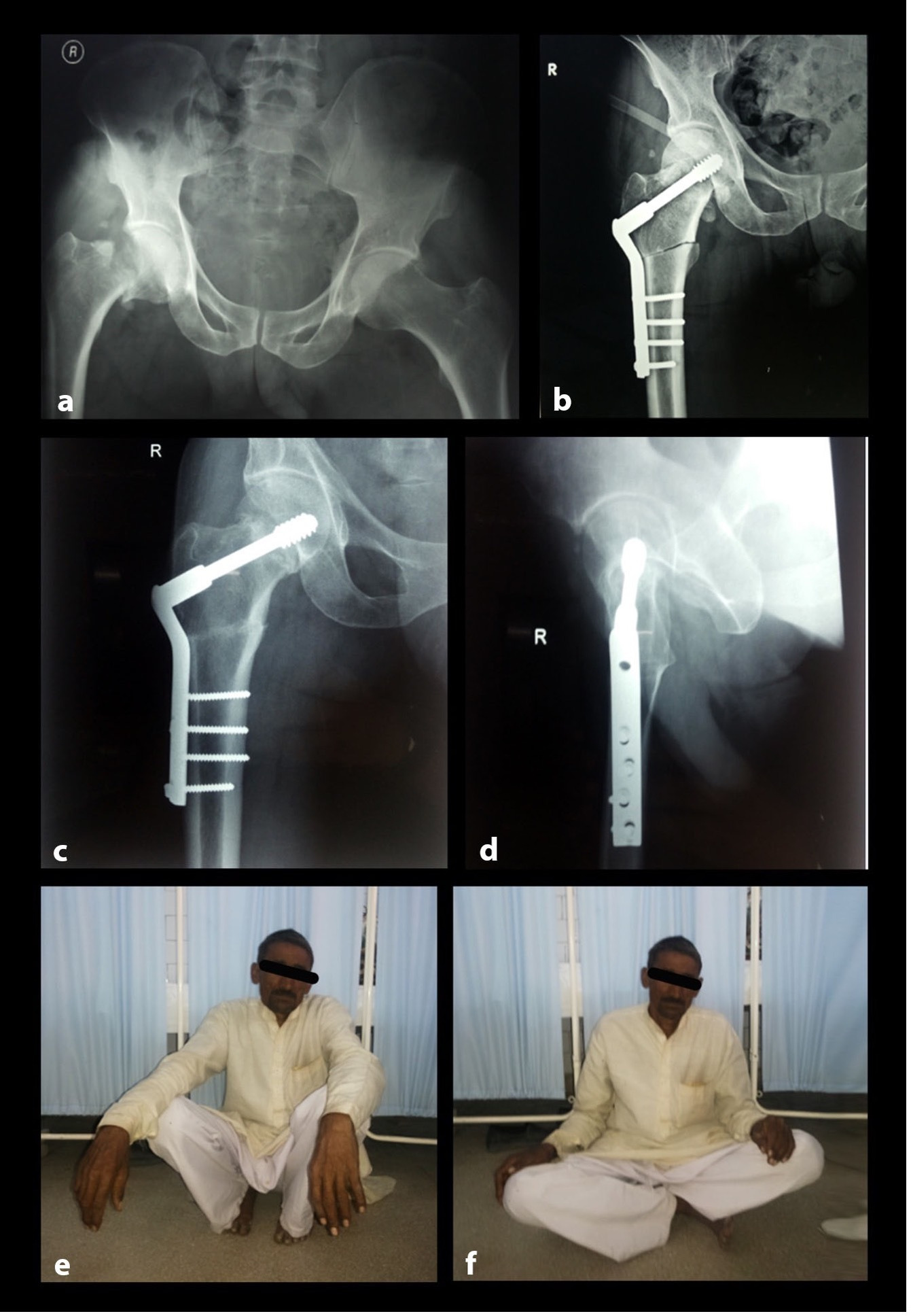 Fig. 4 
            Clinical case of the valgus hip osteotomy and operative fixation technique. a) Preoperative pelvic radiograph showing right Garden 3 fracture neck of femur. b) Postoperative radiograph showing intertrochanteric osteotomy and fracture fixation using a double-angled dynamic hip screw. c) and d) Three-year radiograph showing healing of fracture and osteotomy union. No osteonecrosis is visualized. e) and f) Patient capabilities at three-year follow-up (full squatting and cross-legged sitting).
          