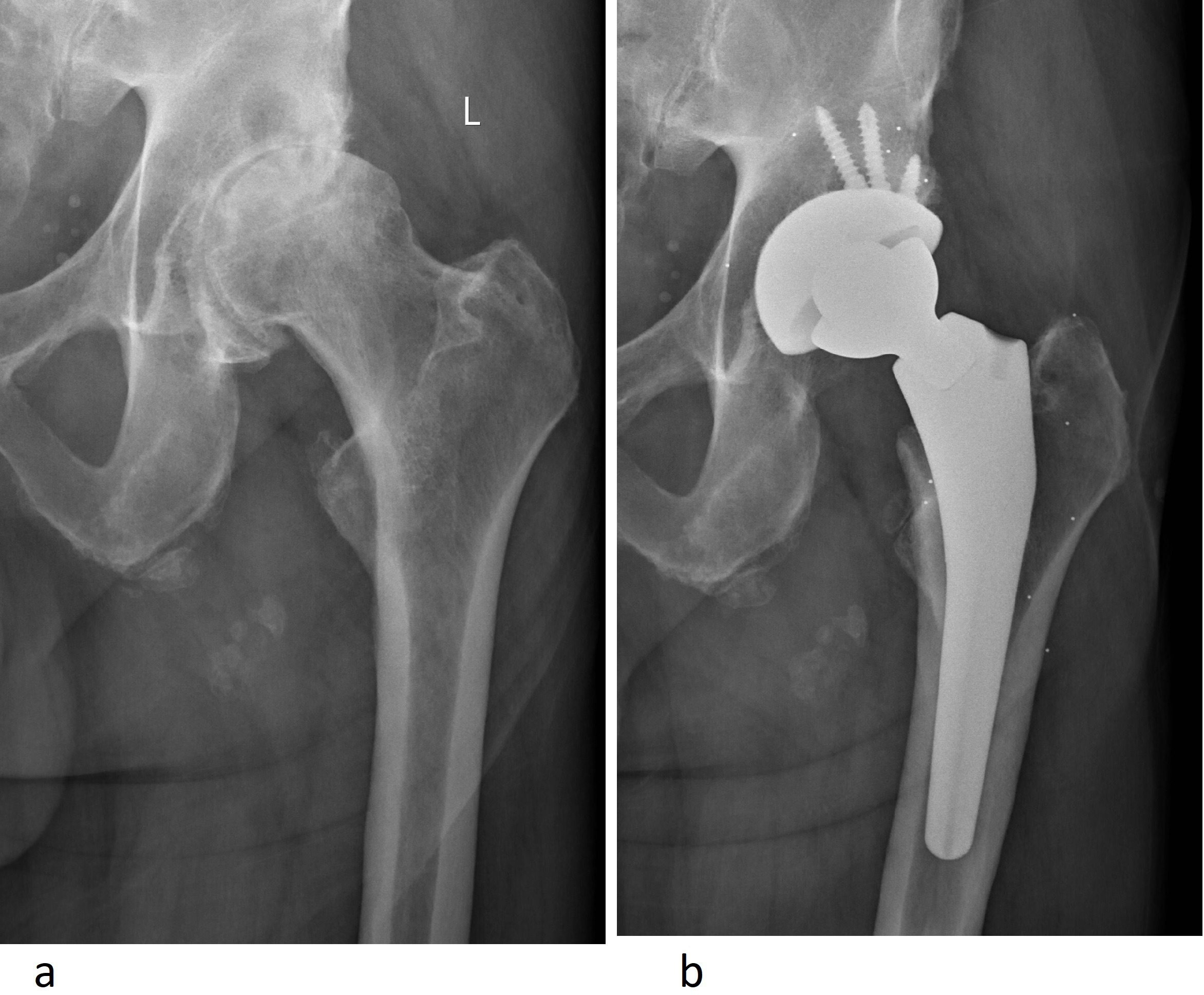 Fig. 2 
          a) Pre- and b) postoperative radiographs of the Hip Innovation Technology Hip Replacement System implanted with radiostereometric analysis beads.
        