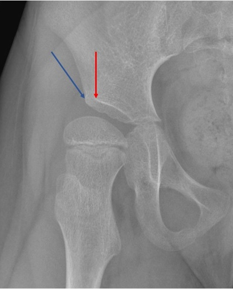 Fig. 1 
          Anteroposterior radiograph of right hip. Red arrow indicates the lateral edge of the sourcil used in the modified method, while the blue arrow indicates the lateral edge of the acetabulum used in the classic method.
        