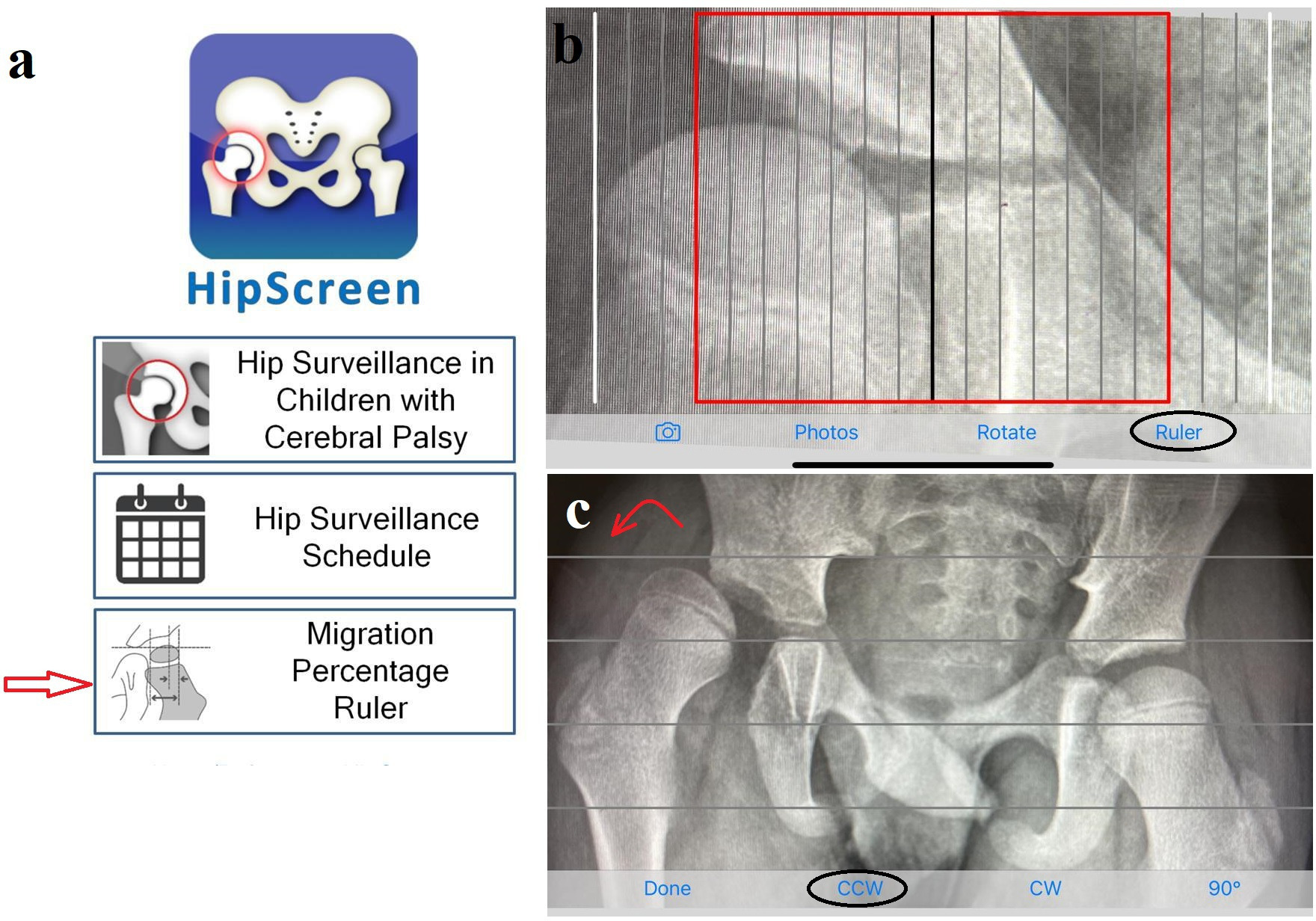 Fig. 2 
          a) Home screen of the HipScreen app, with red arrow pointing to the ruler function. b) Ruler with the red line indicating 30% migration percentage. c) Rotate function to correct pelvic obliquity; in this radiograph counter-clockwise (CCW) is needed (red curved arrow). CW, clockwise.
        
