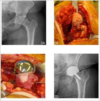 Fig. 2 
          Preoperative anteroposterior radiographs a) of a 31-year-old male with femoroacetabular impingement. Intraoperative photos (b) demonstrate the deformity before and after resurfacing. Eight-year postoperative radiographs (c and d) demonstrate HRA with excellent fixation, no loosening or subsidence, and minimal asymptomatic heterotopic ossification.
        
