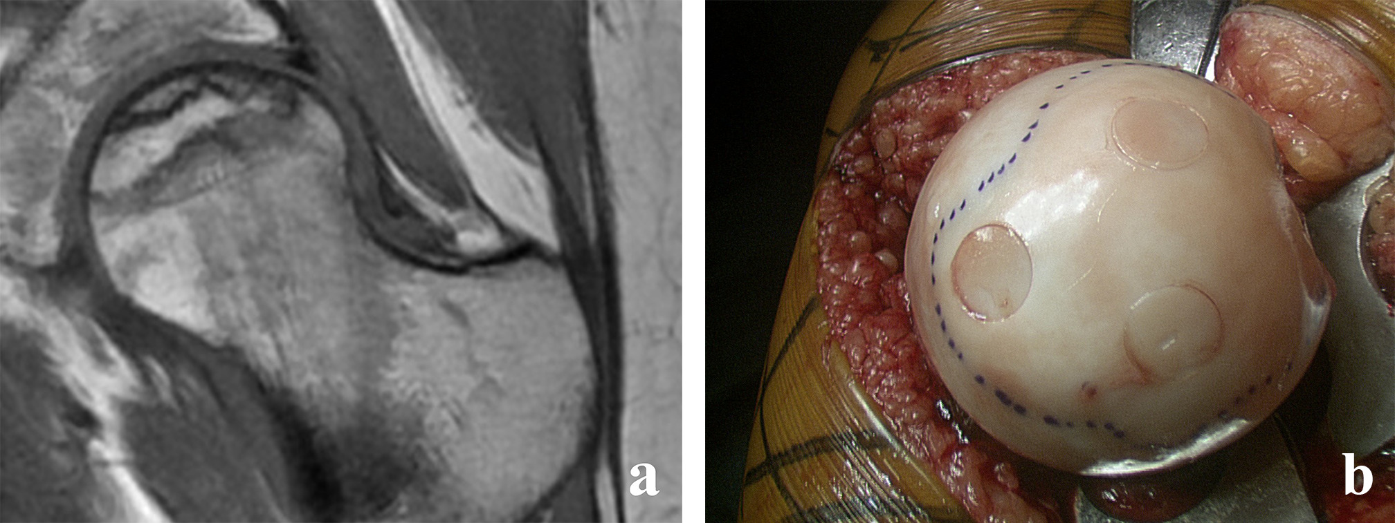 Fig. 3 
          a) Preoperative coronal MRI of a 22-year-old female patient with lupus erythematosus presenting with stage IIB avascular necrosis of the femoral head. b) Intraoperative view showing the stabilization of the necrotic area with careful implantation of three hip-to-hip transplants.
        