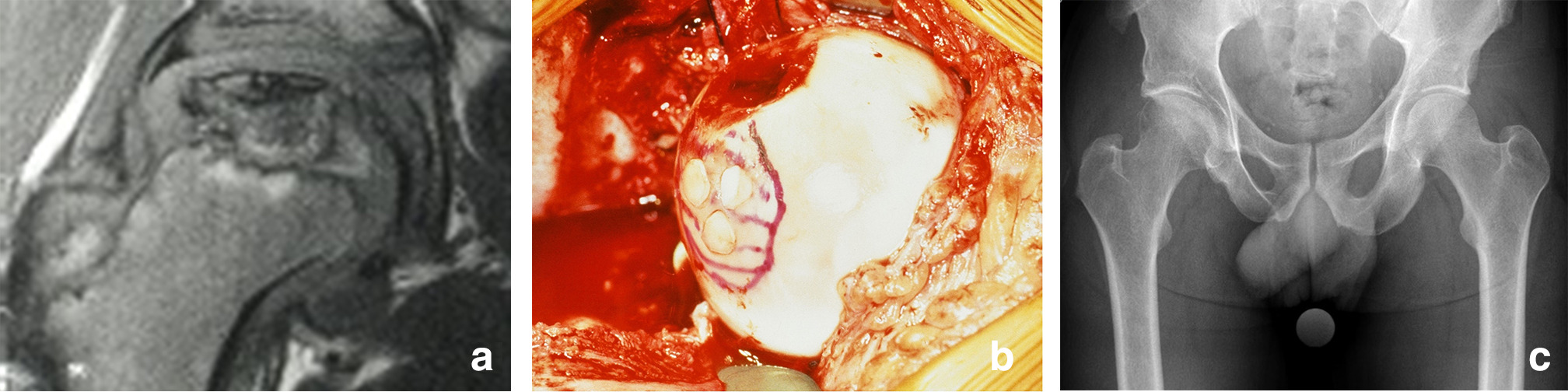 Fig. 4 
          a) Eight-year-old male patient with Perthes’ disease. Coronal MRI indicating the extent of the necrosis as well as a slight lateral extrusion of the femoral head. b) Intraoperative view showing the stabilization of the necrotic area with three osteochondral autografts taken from the ipsilateral knee joint. c) Anteroposterior pelvis views of the same patient at last follow-up, 24.7 years after the index procedure, shows a clinical and radiologically normal right hip joint.
        