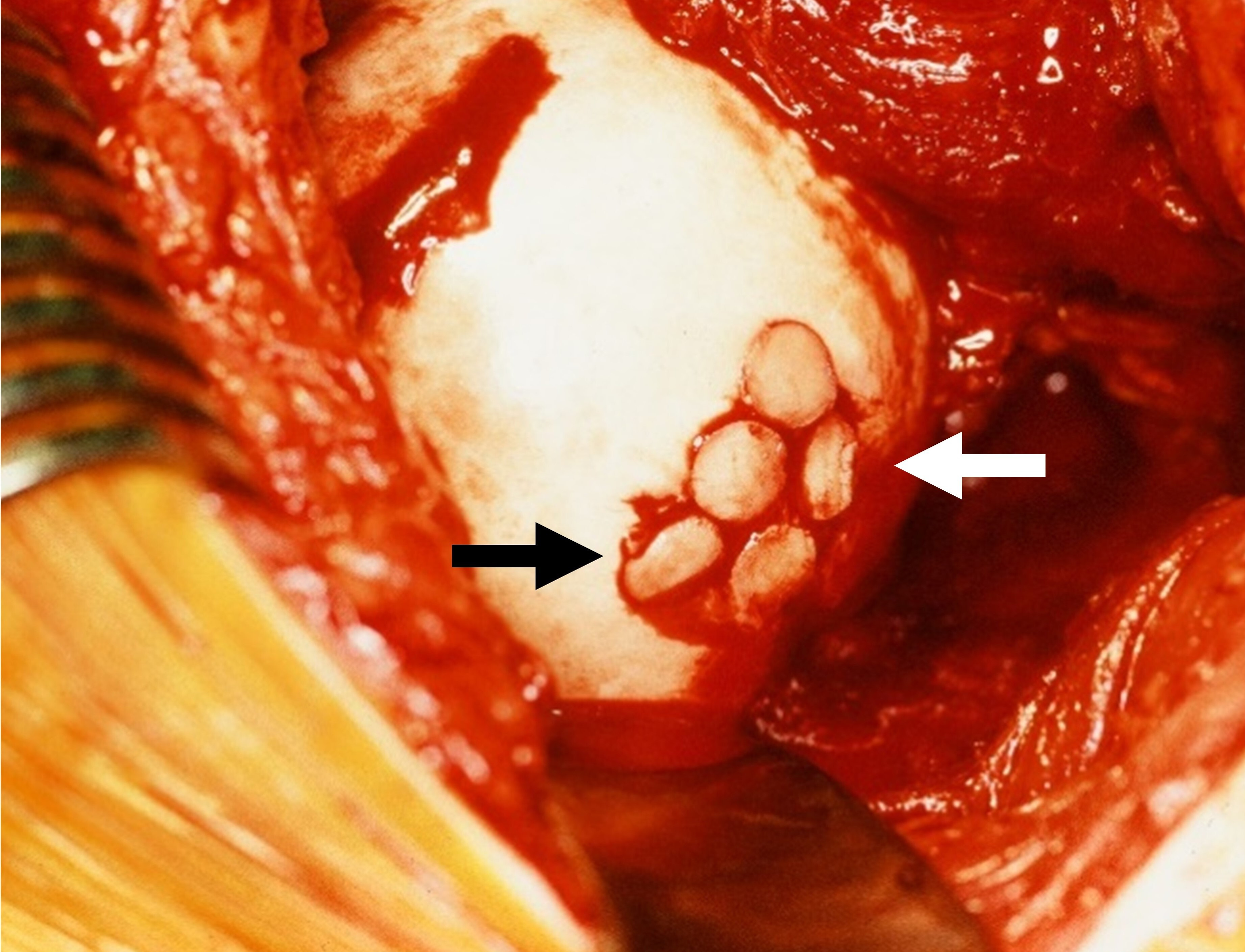 Fig. 5 
          A 29-year-old male patient with stage IIA avascular necrosis of the femoral head treated with osteochondral auto- or allograft transfer (OAT). The grafts were taken from the ipsilateral knee joint. In knee-to-hip transfer, perfect reconstruction is difficult to obtain from a technical perspective. The intraoperative view shows an incongruous femoral head surface due to incorrect placement of two grafts (arrows). At 23.8 years’ follow-up, this patient had not undergone conversion to THA.
        