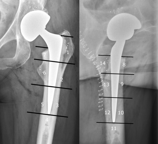 Fig. 3 
            Anterior/posterior and cross-table lateral radiographs of a right hip with Exeter short stem. Modified Grüen zones were used in the radiographic evaluation. The periprosthetic bone was evenly divided from tip to shoulder. Proximal zones ended with the cement mantle. The zones were numbered from lateral to medial and from anterior to posterior.
          