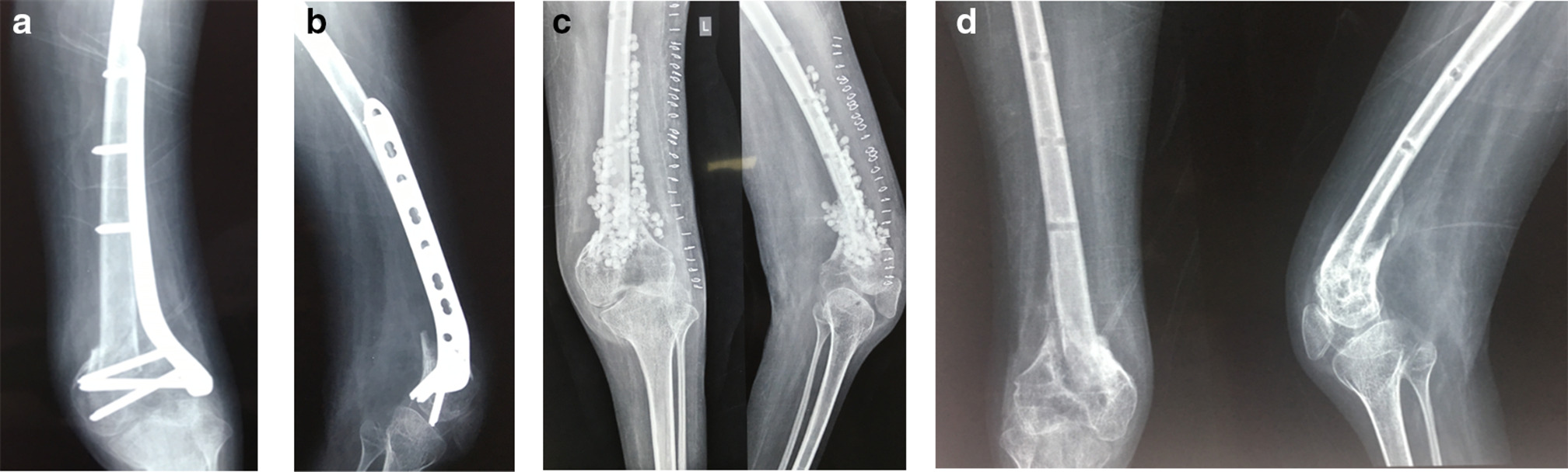 Fig. 2 
            a) 29-year-old male with post-polio residual paralysis and type 1 open fracture. Following debridement and ORIF with reversed proximal tibial plate (to match the hypoplastic bone). Presented a year later with pseudomonas infection following closed injury and haematoma formation. b) Lateral view of distal femur with knee, demonstrating the distal femoral fracture and plate fixation. c) Anteroposterior (AP) and lateral views of distal femur with knee, following wound debridement, implant removal, and Stimulan insertion. d) AP and lateral views of distal femur with knee demonstrating good healing of distal femoral fracture at six months' follow-up.
          