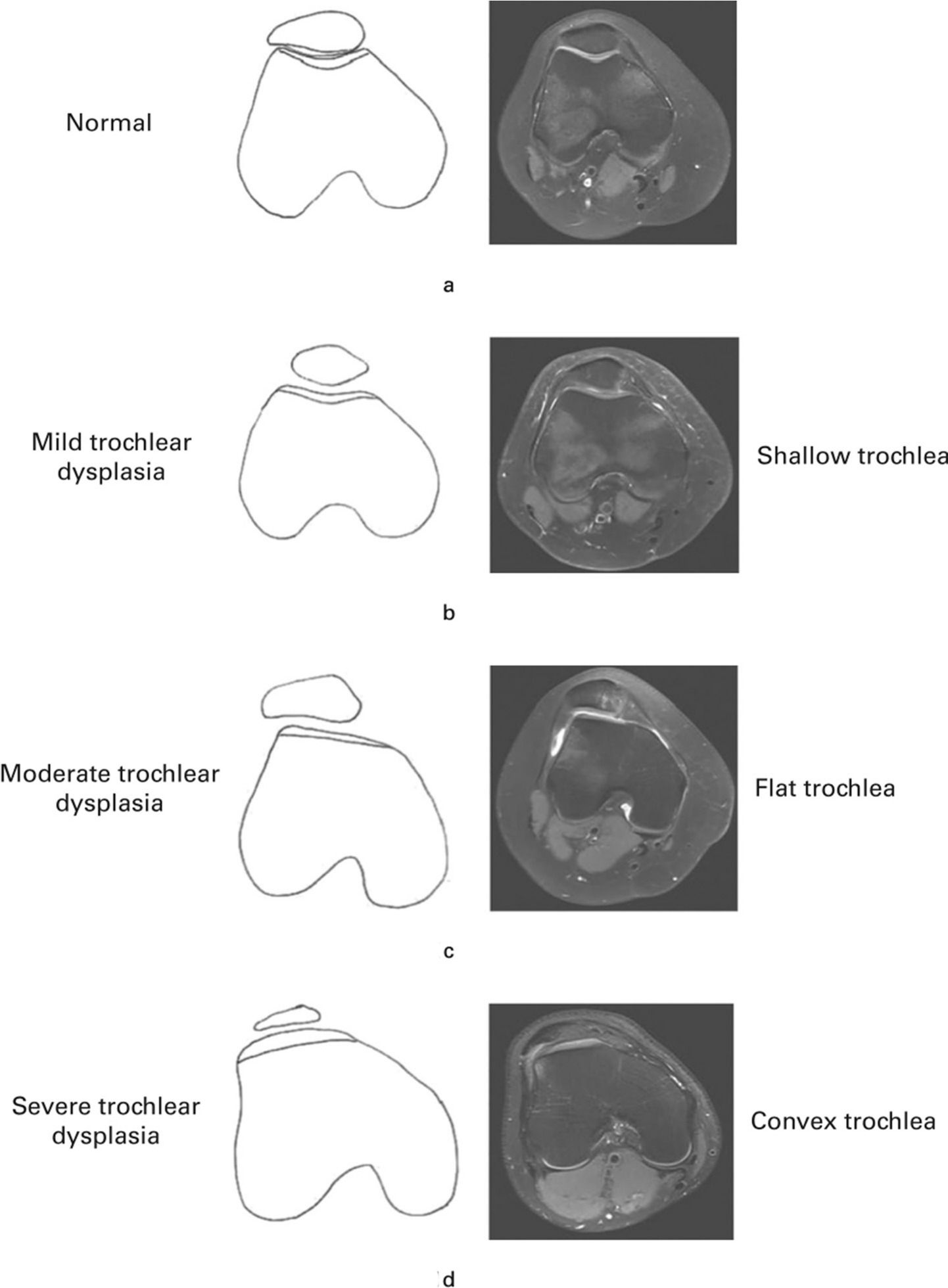 Fig. 1 
          Oswestry-Bristol Classification (illustration and MRI reproduced with permission from Sharma et al).6
        