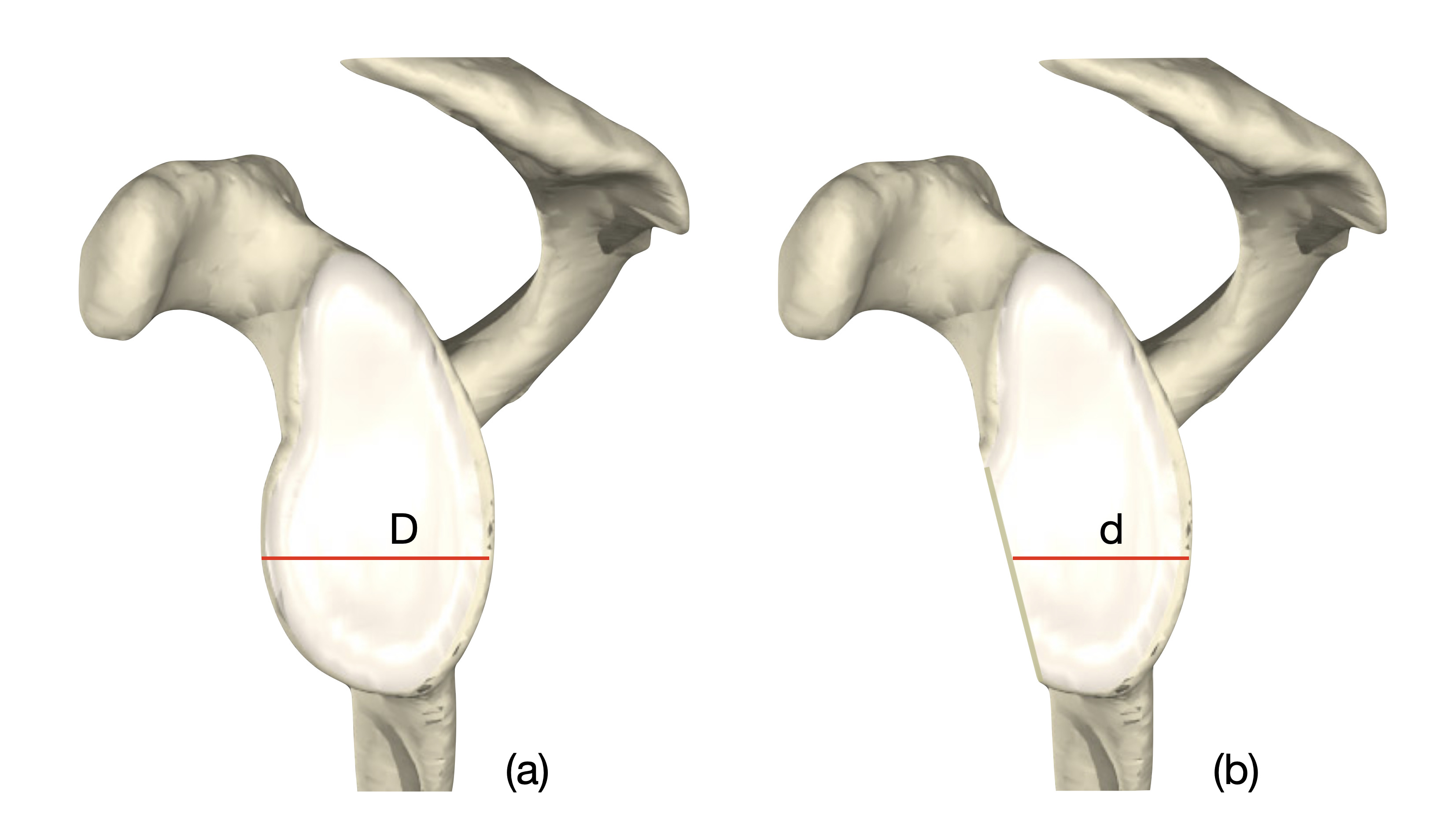 Fig. 2 
            Relative diameter technique. The diameter of the injured glenoid (d) is expressed as a percentage of the diameter of the contralateral glenoid (D).
          