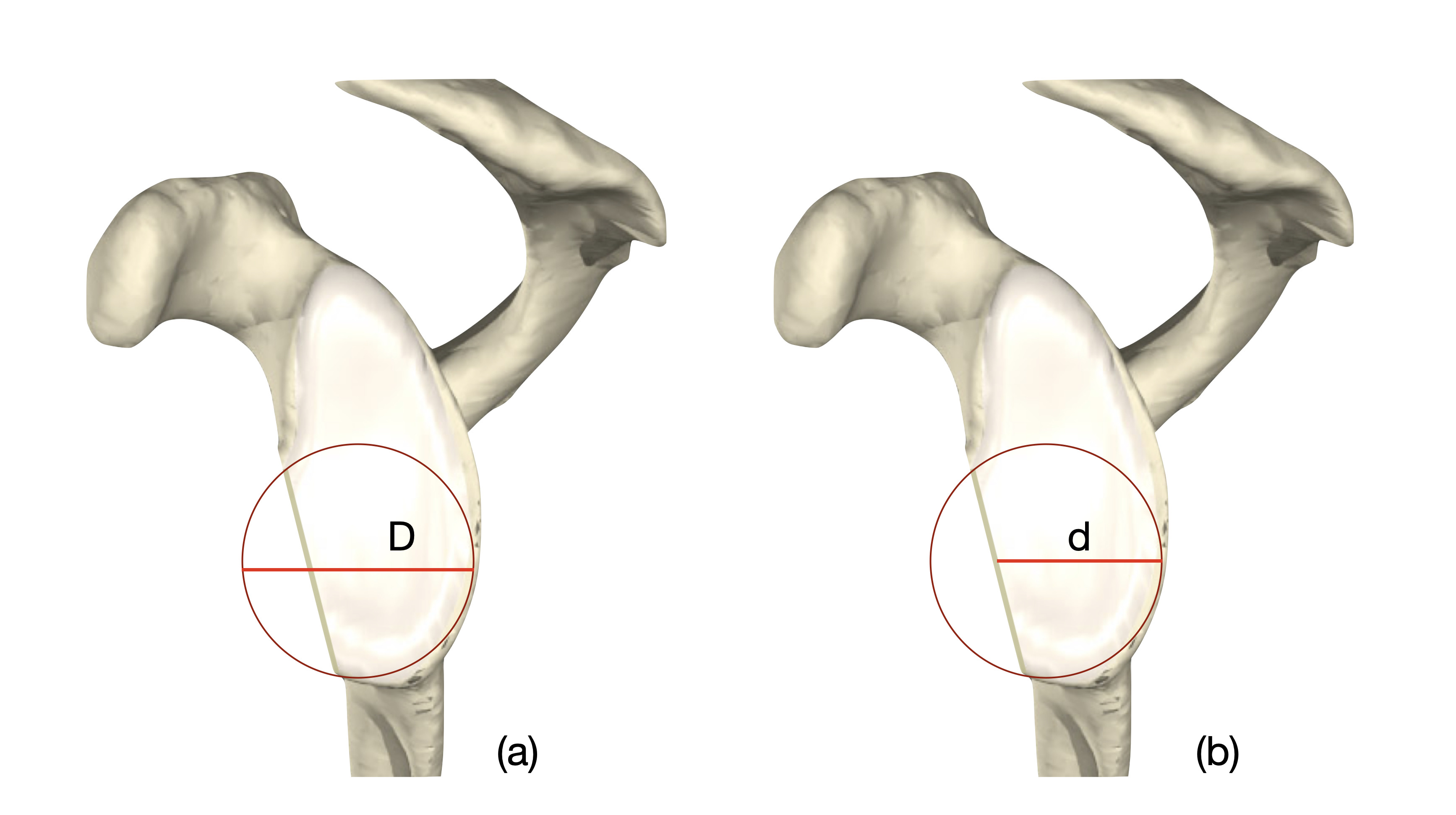 Fig. 3 
            Linear ipsilateral COBF The diameter of the injured glenoid (d) is expressed as a percentage of the diameter of the circle of best fit (D).
          