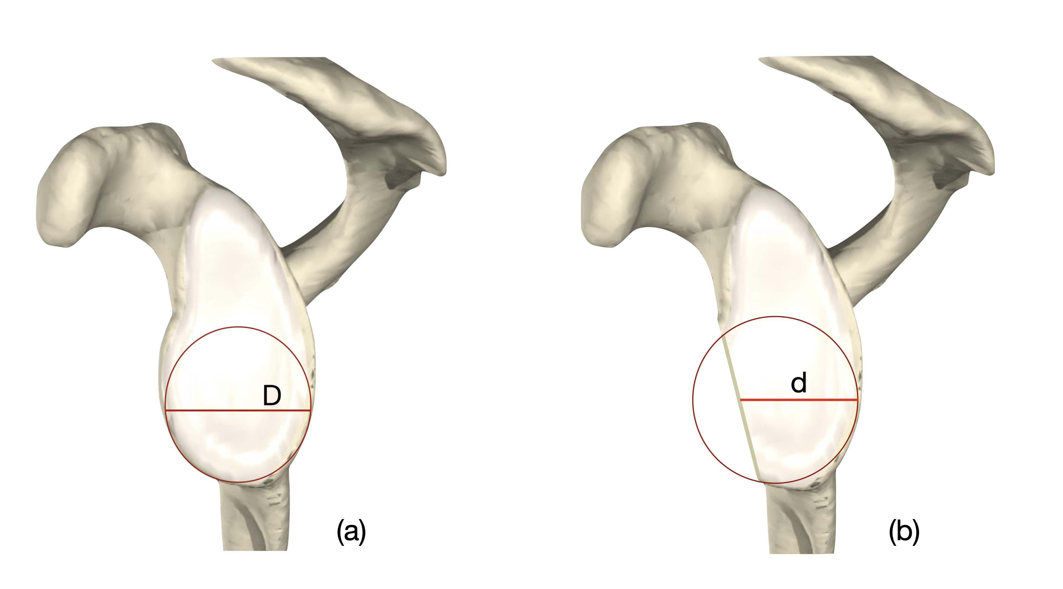 Fig. 4 
            Linear contralateral circle of best fit (COBF). The diameter of the remaining glenoid (d) is expressed as a percentage of the diameter of the COBF (D) obtained from the contralateral glenoid.
          