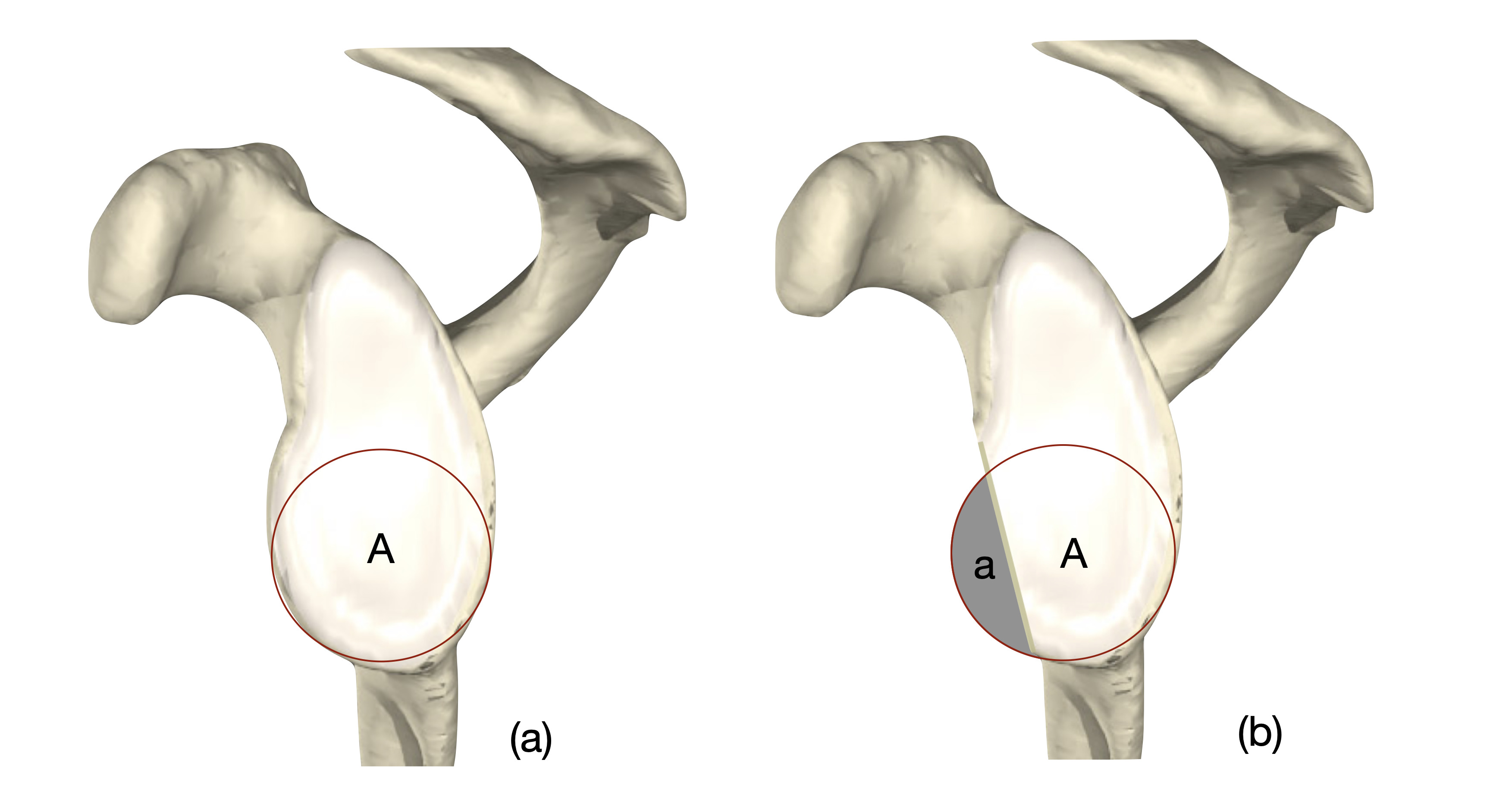 Fig. 5 
            Pico technique (area contralateral circle of best fit (COBF). A COBF from the contralateral glenoid is applied to the injured side. The area of the defect is expressed as a percentage of the total area. The Sugaya technique (REF) is the same but derives a COBF from the ipsilateral glenoid.
          