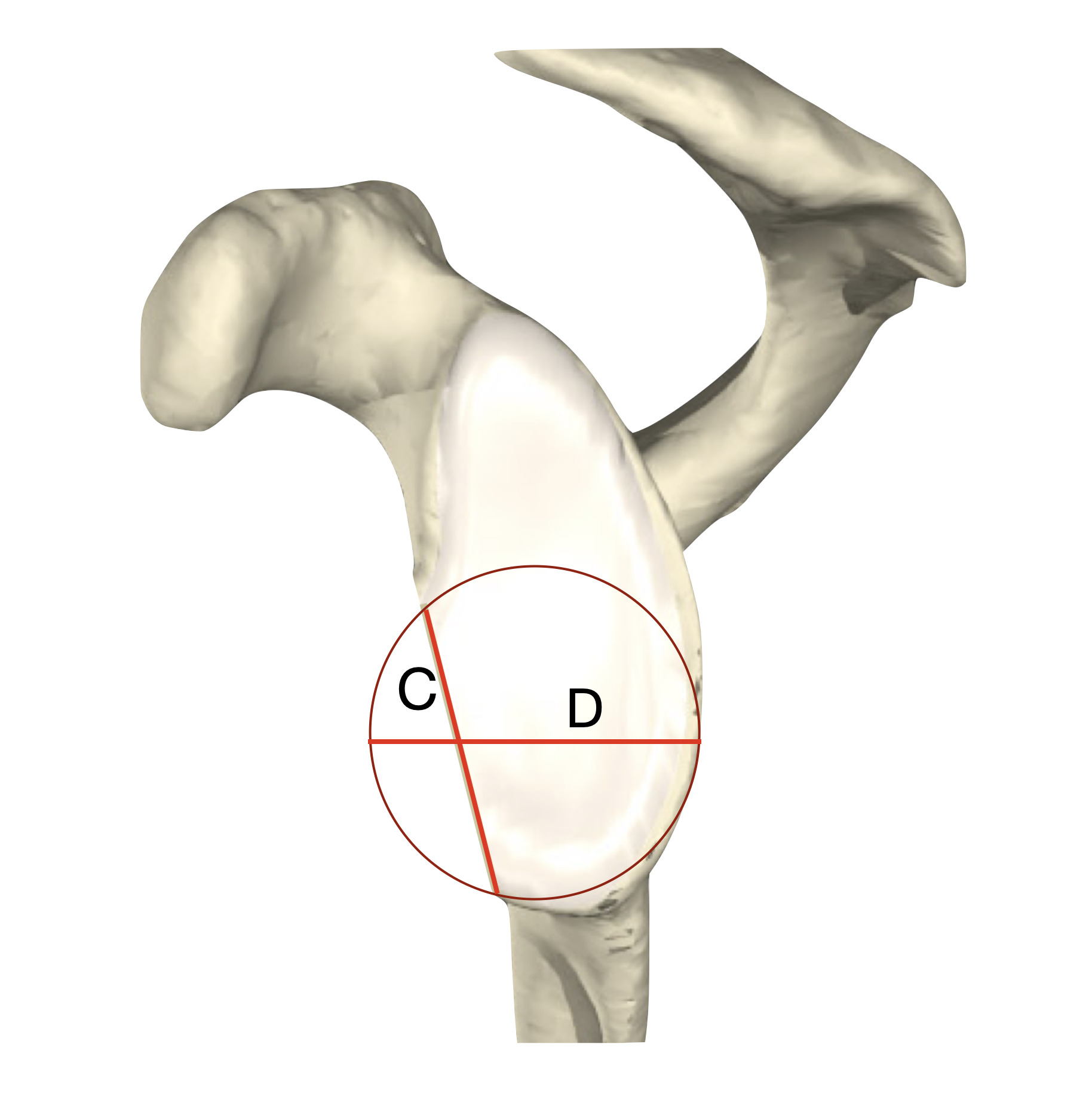 Fig. 6 
            Circle line method (Parada technique) an ipsilateral circle of best fit (COBF) is generated. The length of the anterior glenoid is measured between the two points at which it intersects the COBF (C).
          
