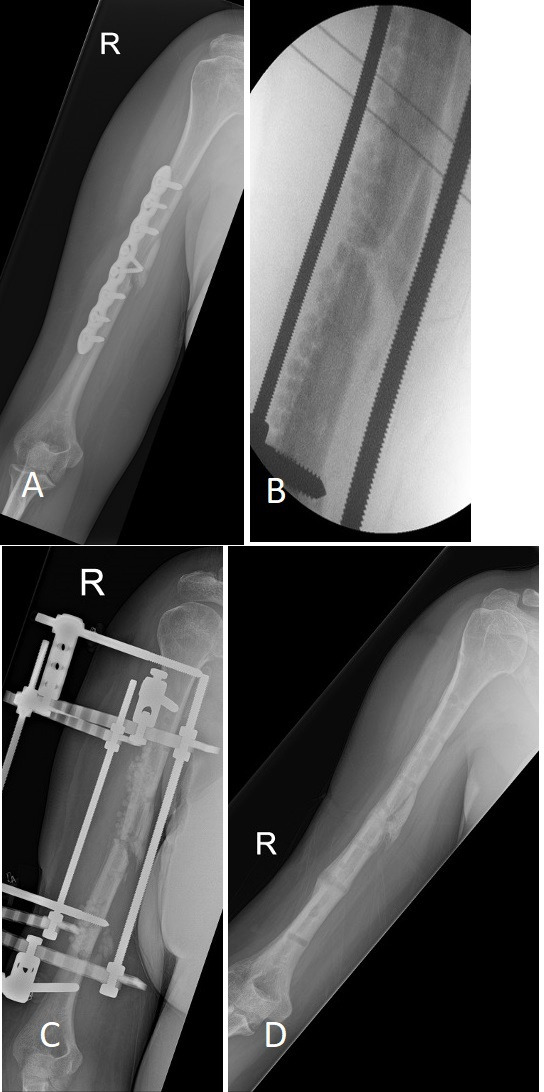 Fig. 2 
            a) 39-year-old female type A host with infected nonunion of humerus fracture after open reduction and internal fixation. b) Intraoperative radiograph after plate removal, local antibiotics, and stabilization with frame. No wide resection was done. c) Interim radiograph showing good alignment and partial resorption of local antibiotics. d) Post removal of frame showing good union, no clinical signs and symptoms of recurrence of infection at 18 months after surgery.
          