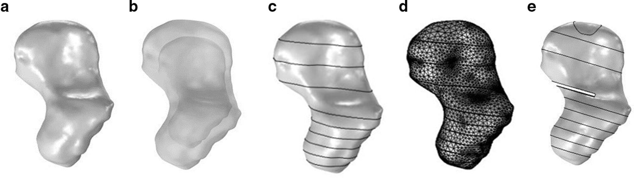 Fig. 1 
          a) 3D scaphoid model. b) Subchondral and cancellous scaphoid. c) 3D scaphoid model divided into the aforementioned region. d) Scaphoid mesh. e) Finalized fractured scaphoid model. Circle around distal pole represents where the 100 N compressive load was applied.
        