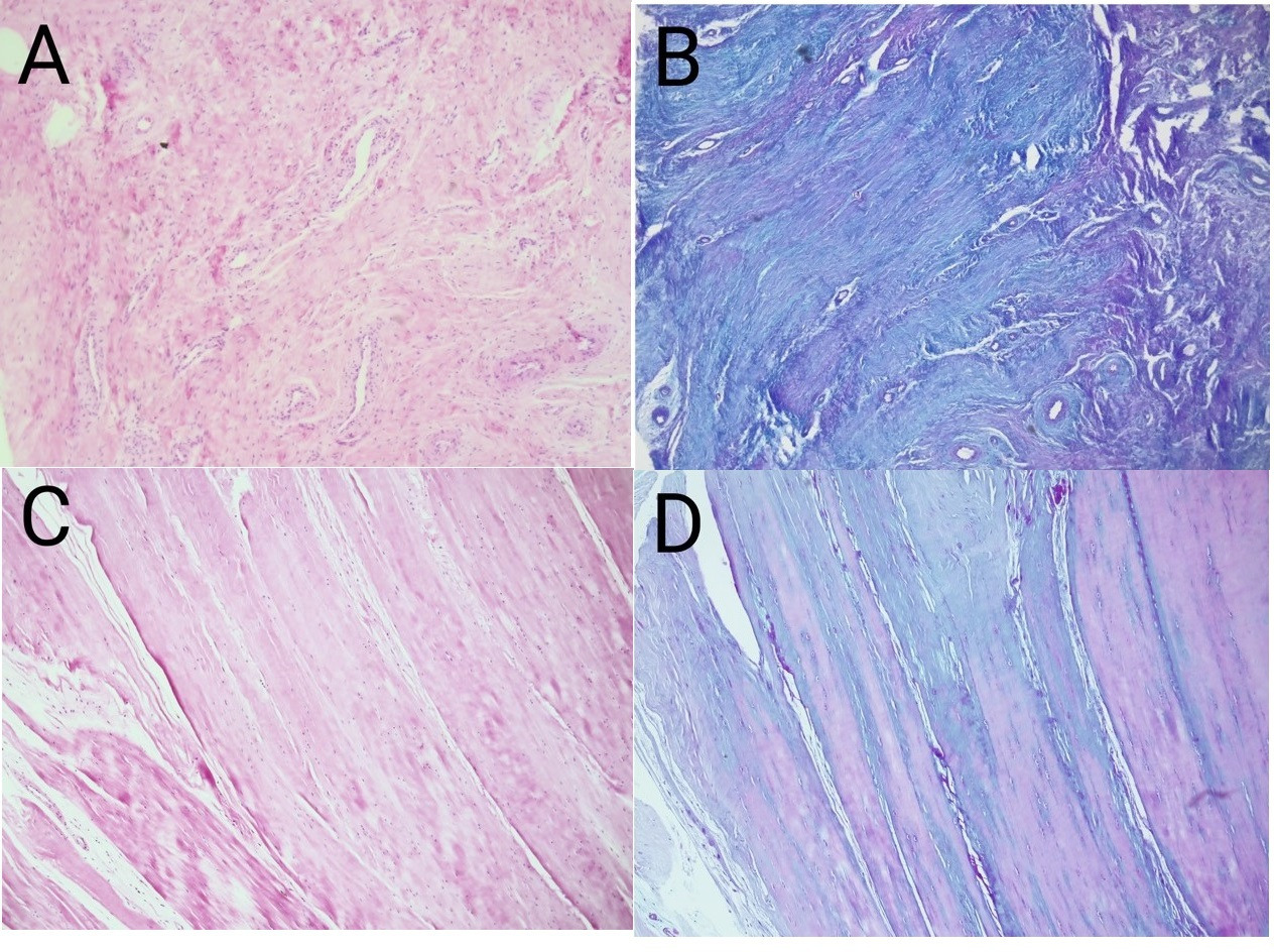 Fig. 2 
          Biopsy specimens a) and b) were obtained at revision from a 78-year-old male patient with a periprosthetic joint infection after total hip arthroplasty performed using a lateral approach. a) depicts the deterioration of fibres, with several vessels within the dense connective tissue. b) Rich glycosaminoglycan content with markedly increased alcianophilia in the connective tissue. Biopsy specimens c) and d) were obtained at revision from a 77-year-old male patient with cup and stem loosening, who had previously undergone a hip joint arthroplasty via a lateral approach. The light-microscopic views show c) slight separation of fibres and few vessels. d) A moderate increase in alcianophilia (blue staining) between the pink-stained collagen fibres.
        