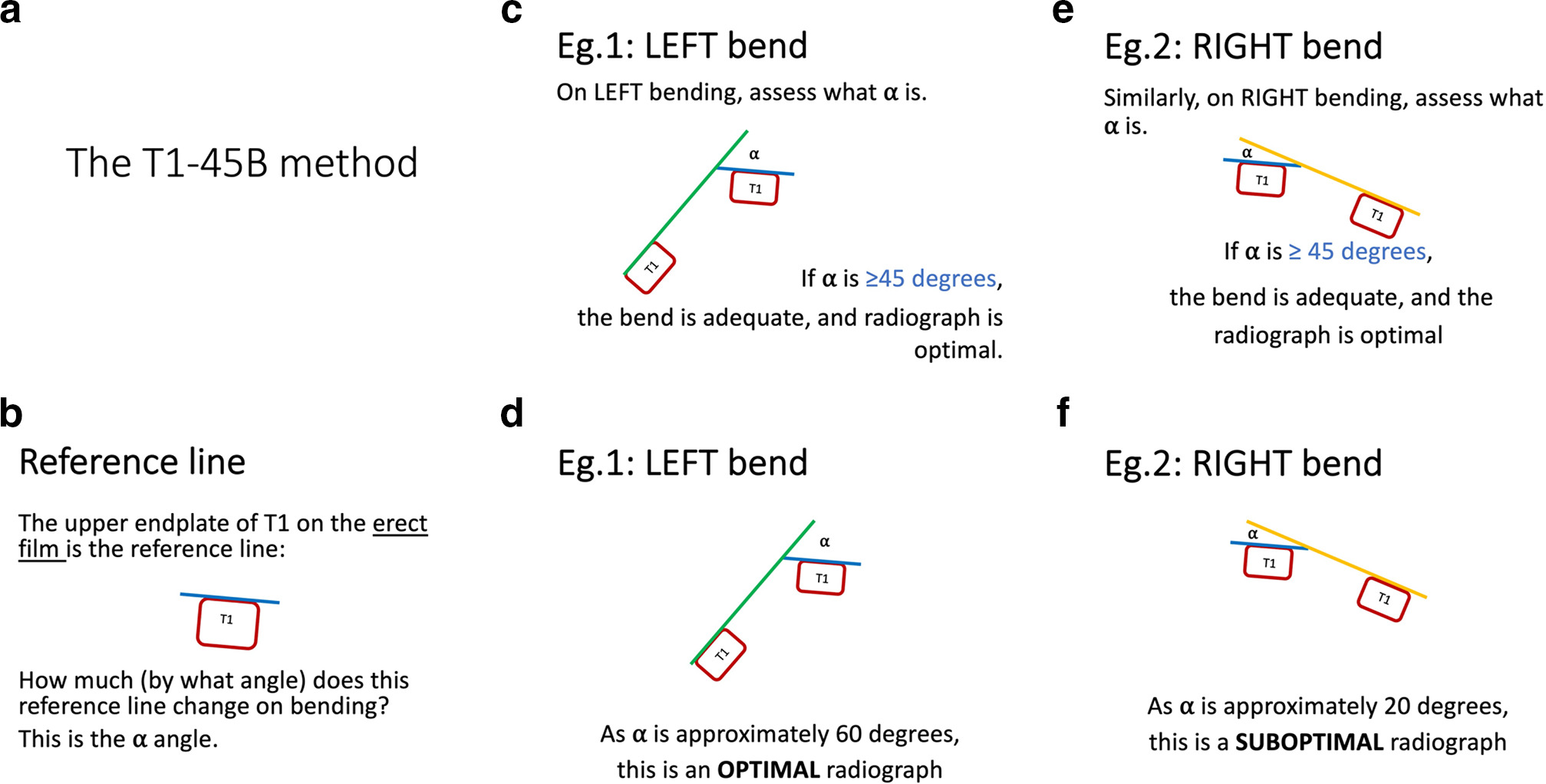 Fig. 1 
            a) and b) The reference line used in the T1-45B method. c) and d) An adequate left bend effort and optimal study. e) and f) An inadequate right bend effort and suboptimal study.
          