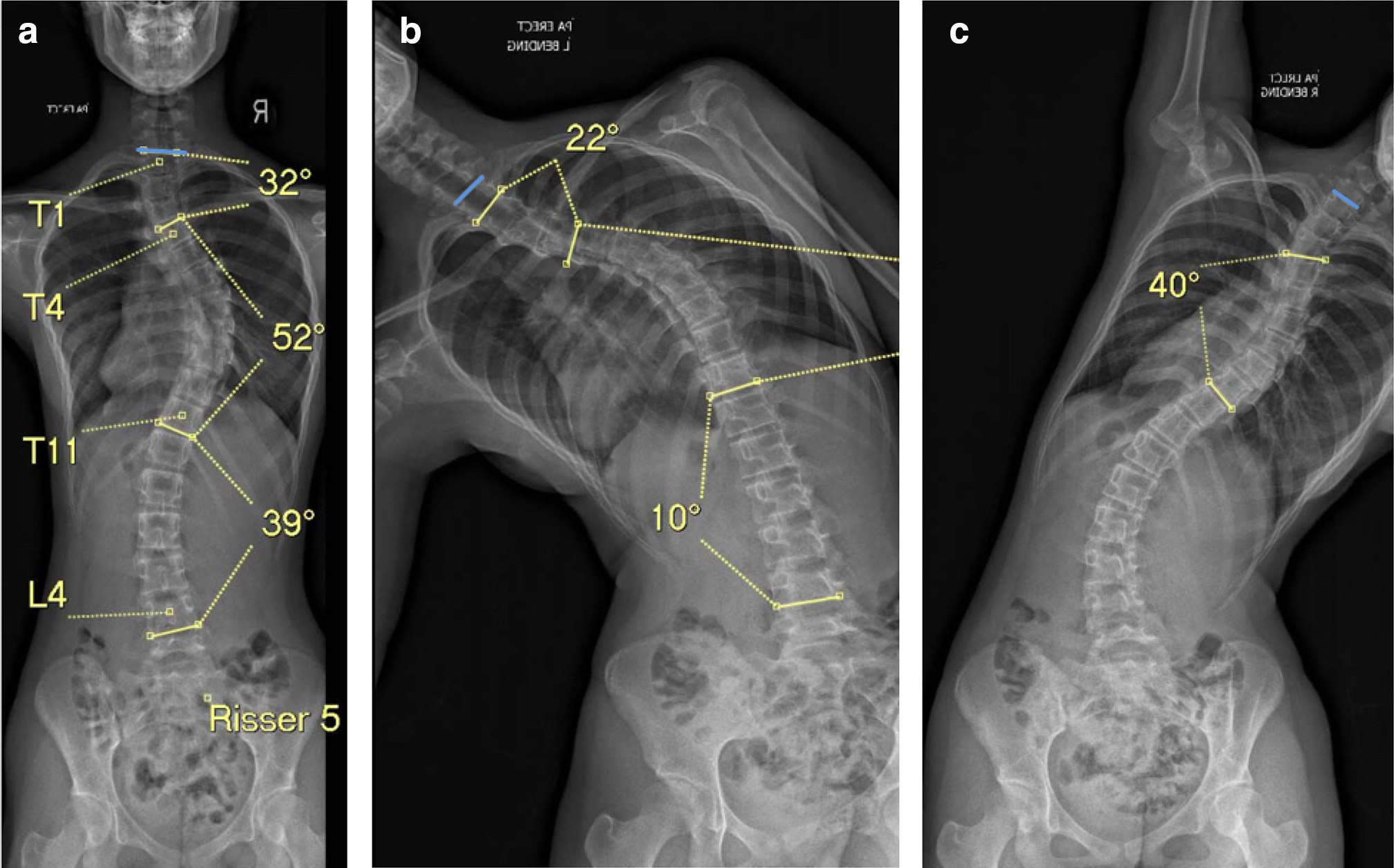 Fig. 2 
            a) Erect radiograph with upper endplate of T1 highlighted (for Survey 3). b) Optimal left bending radiograph. c) Suboptimal right bending radiograph.
          