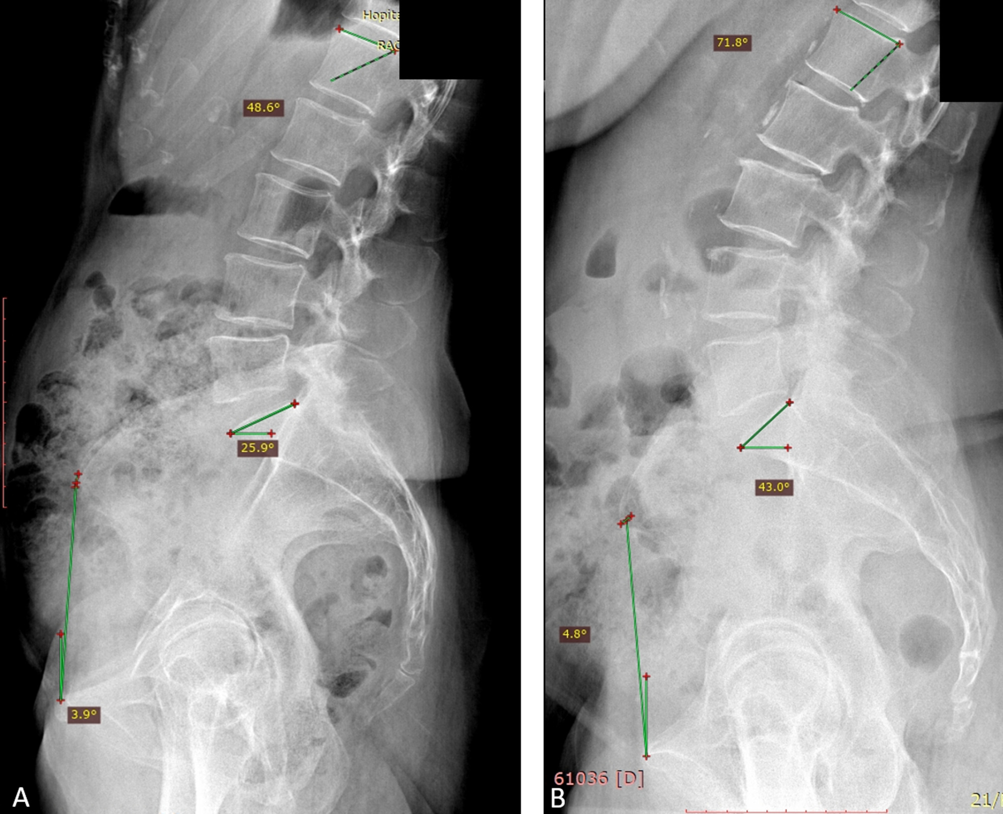 Fig. 3 
            Type of lumbar shape in patients with low pelvic incidence (PI) in lateral standing radiographs. a) Patient with low PI and low lordosis. PI = 38°, spinopelvic tilt (SPT) = -4°, lumbar lordosis (LL) 49°, sacral slope (SS) 26°, and lumbar apex at level L5. b) Patient with low anteverted PI 39°, SPT 5°, LL 71°, SS 42°, and lumbar apex at level L4.
          
