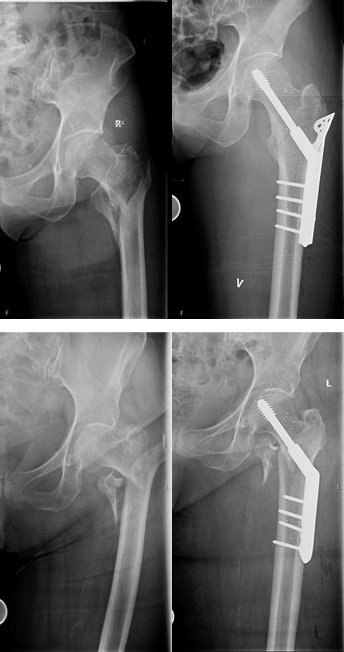 Fig. 1 
          Examples of included AO/OTA 31-A2 fractures. Pre- and postoperative radiographs.
        