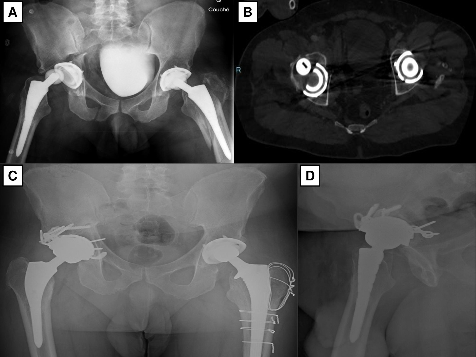 Fig. 1 
            Patient 1: Male aged 49 years with a transverse periprosthetic acetabular fracture, a posterior hip prosthesis dislocation and a probably stable acetabular implant who have had ORIF with a posterior plate, impacted fragmented bone graft and acetabular reinforcement with a δ Revision TT ring (Lima Corporate) (operative delay from the trauma = five days). a) Anteroposterior (AP) pelvis radiograph. b) Axial CT-scan view. c-d) Postoperative radiographs.
          