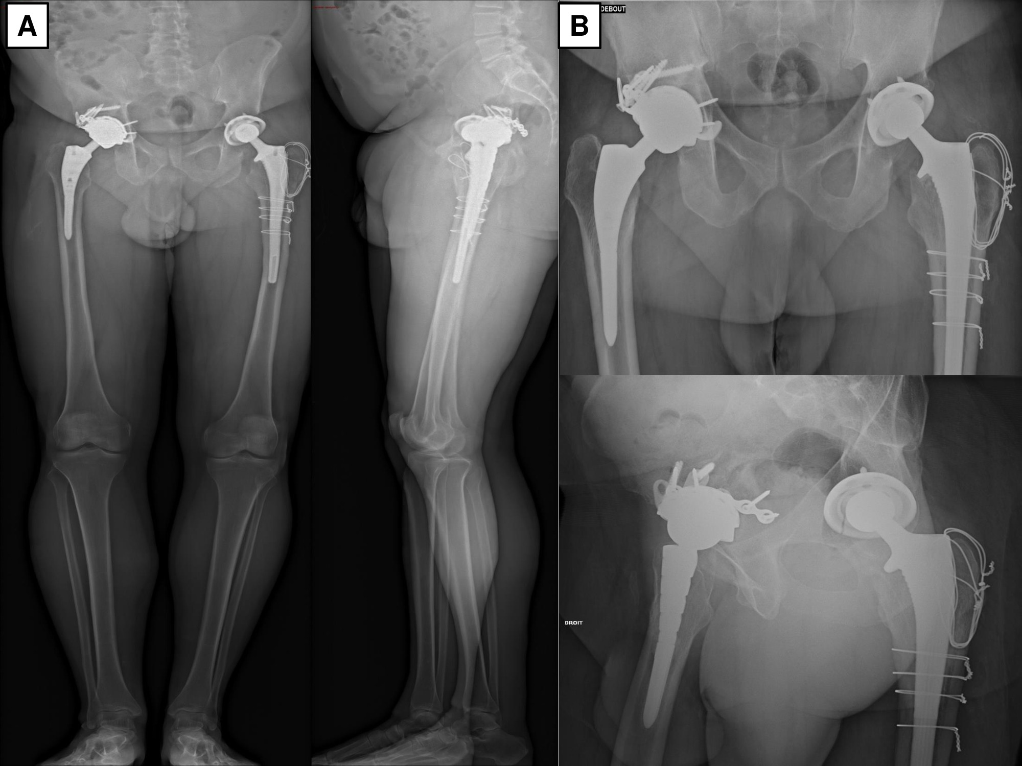 Fig. 2 
            Patient 1. Pangonogram and radiographs at last follow-up (28 months).
          