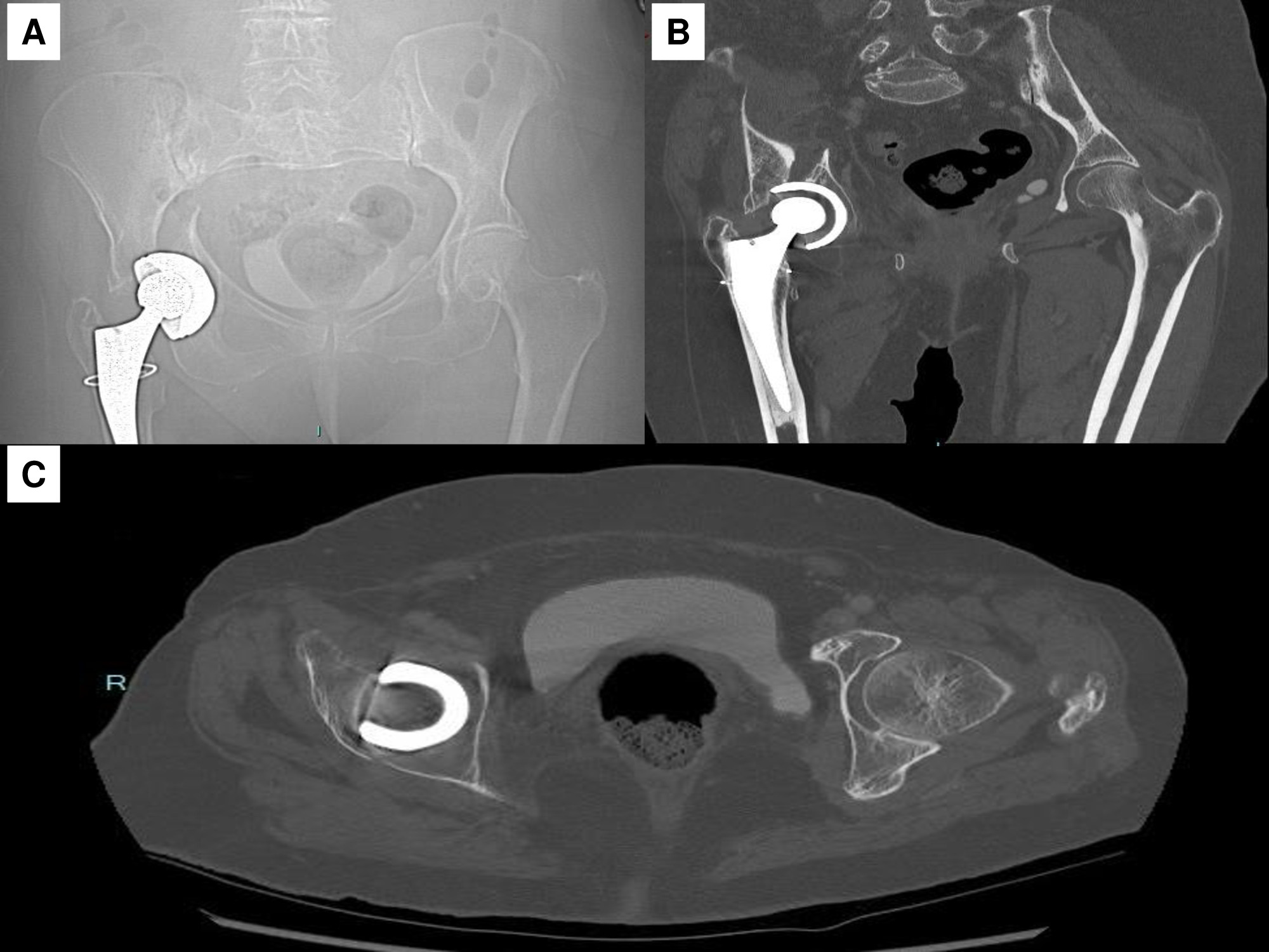 Fig. 3 
            Patient 2: Female aged 82 years with a transverse periprosthetic acetabular fracture and a stable acetabular implant who have had ORIF with a posterior plate (operative delay from the trauma: eight days). a-b) Pelvis scout CT-scan image and a frontal CT-scan view. c) Axial pelvis CT-scan view.
          