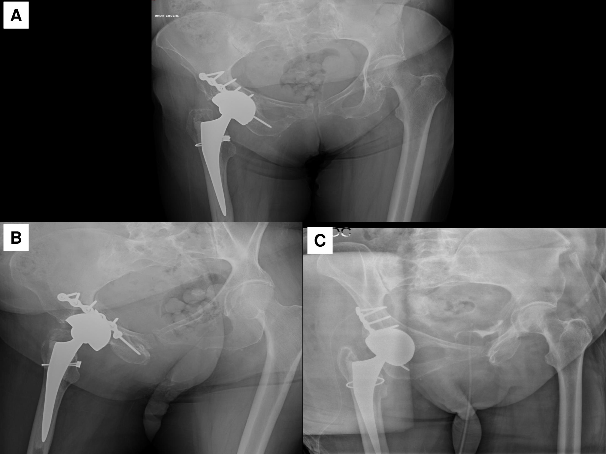 Fig. 4 
            Patient 2. a) Postoperative AP pelvis radiograph. b-c) Postoperative alar and obturator oblique views.
          