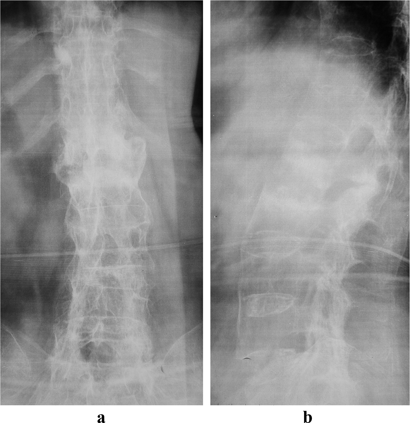 Fig. 1 
            a) Preoperative anteroposterior and b) lateral radiographs of a 42-year-old female patient from the open spinal fusion group who had an Andersson lesion at L1/2. There is a 9° local kyphosis.
          