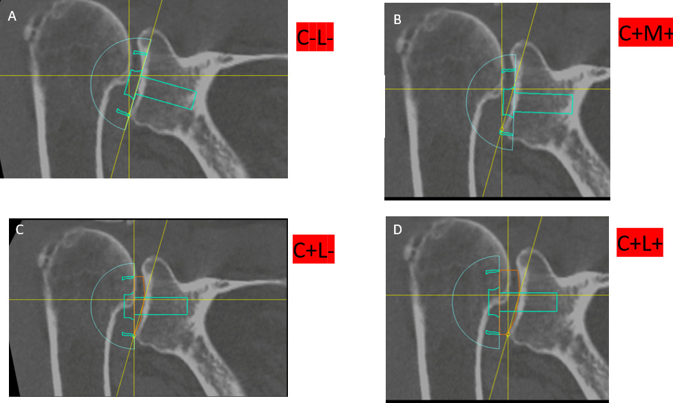 Fig. 1 
            The four tested configurations: a) no correction of the reverse shoulder arthroplasty (RSA) angle and no lateralization(C-L-); b) medialization with correction of the RSA angle (C+M+); c) correction of the RSA angle without lateralization (C+L-); d) correction of the RSA angle with lateralization (C+L+).
          