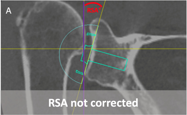 Fig. 2 
            The reverse shoulder arthroplasty (RSA) angle is shown in red. The vertical purple line crosses the inferior glenoid edge and is used as the reference for medialization or lateralization.
          