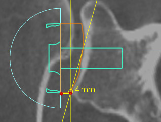 Fig. 3 
            The inferior corner of the glenoid being used as the reference point for 4 mm lateralization.
          