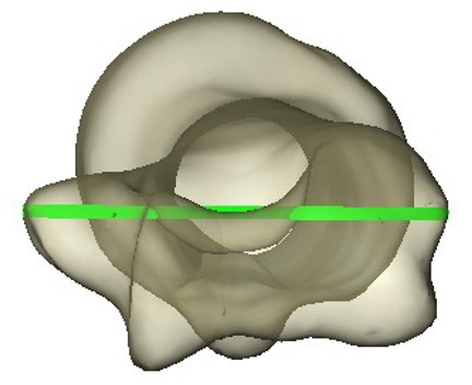 Fig. 2 
          Transepicondylar axis of the humerus.
        