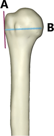 Fig. 3 
          3D image of the greater tubercle of the humerus (A) and transepicondylar axis of the humerus (B).
        