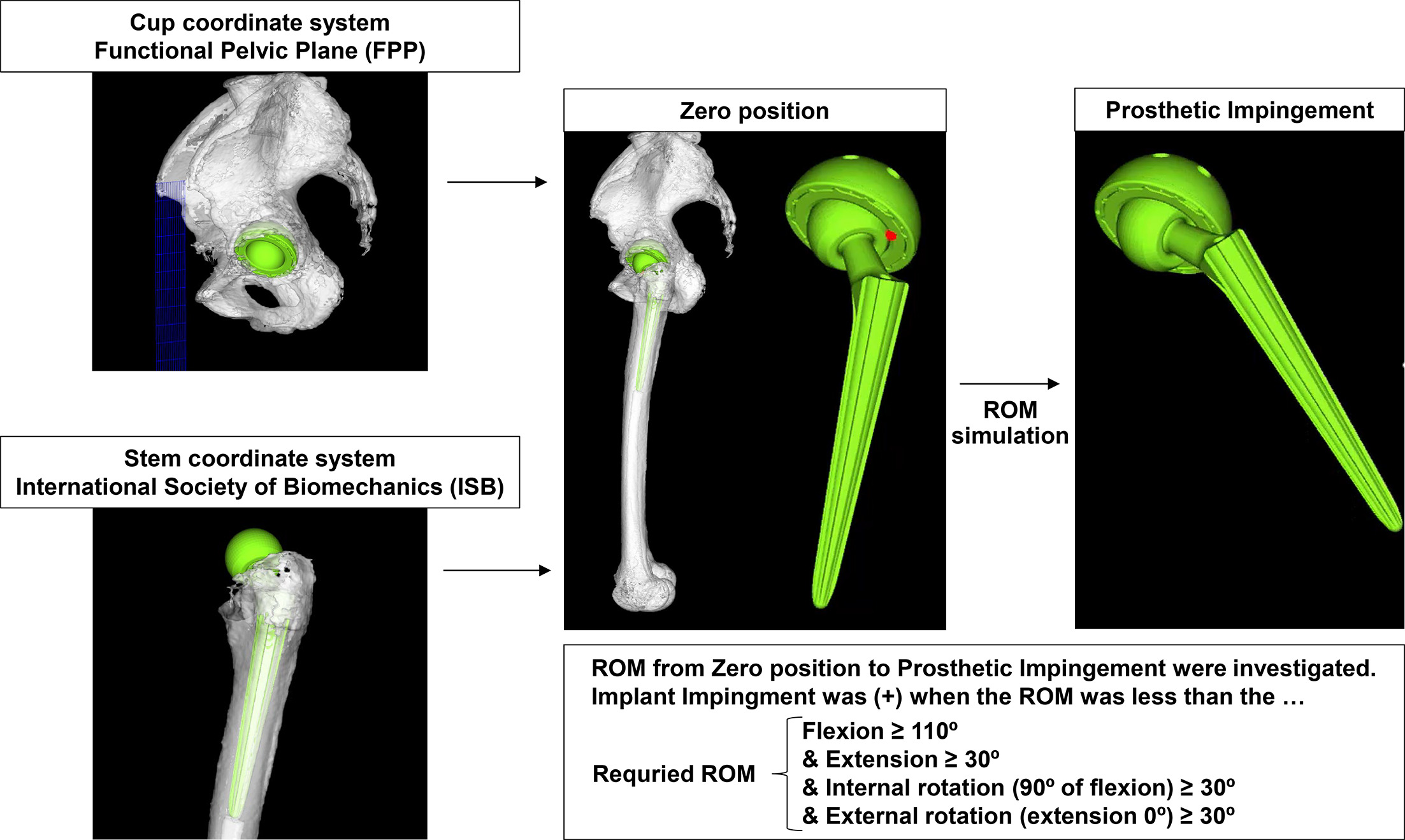 Fig. 2 
            CT-based simulation software (ZedHip; Lexi Co, Ltd, Japan) was used to semi-automatically create virtual 3D bone models, and perform virtual range of motion (ROM) simulation and the probability of prosthetic impingement. The functional pelvic plane (FPP) was used for coordinates of the pelvis, which were defined as follows: 1) the axial reference was the anterior pelvic surface through the right and left superior anterior iliac spines and pubic tuberosity; 2) the anterior-posterior axis was tilted according to the inclination of the anterior pelvic surface when the patient was lying supine on the CT table. The femoral coordinate system was defined, as per the International Society of Biomechanics,10 as being the centre of the femoral head, knee centre, and both femoral condyles. The alignment of the cup and stem and combined anteversion were measured based on the coordinate systems.
          