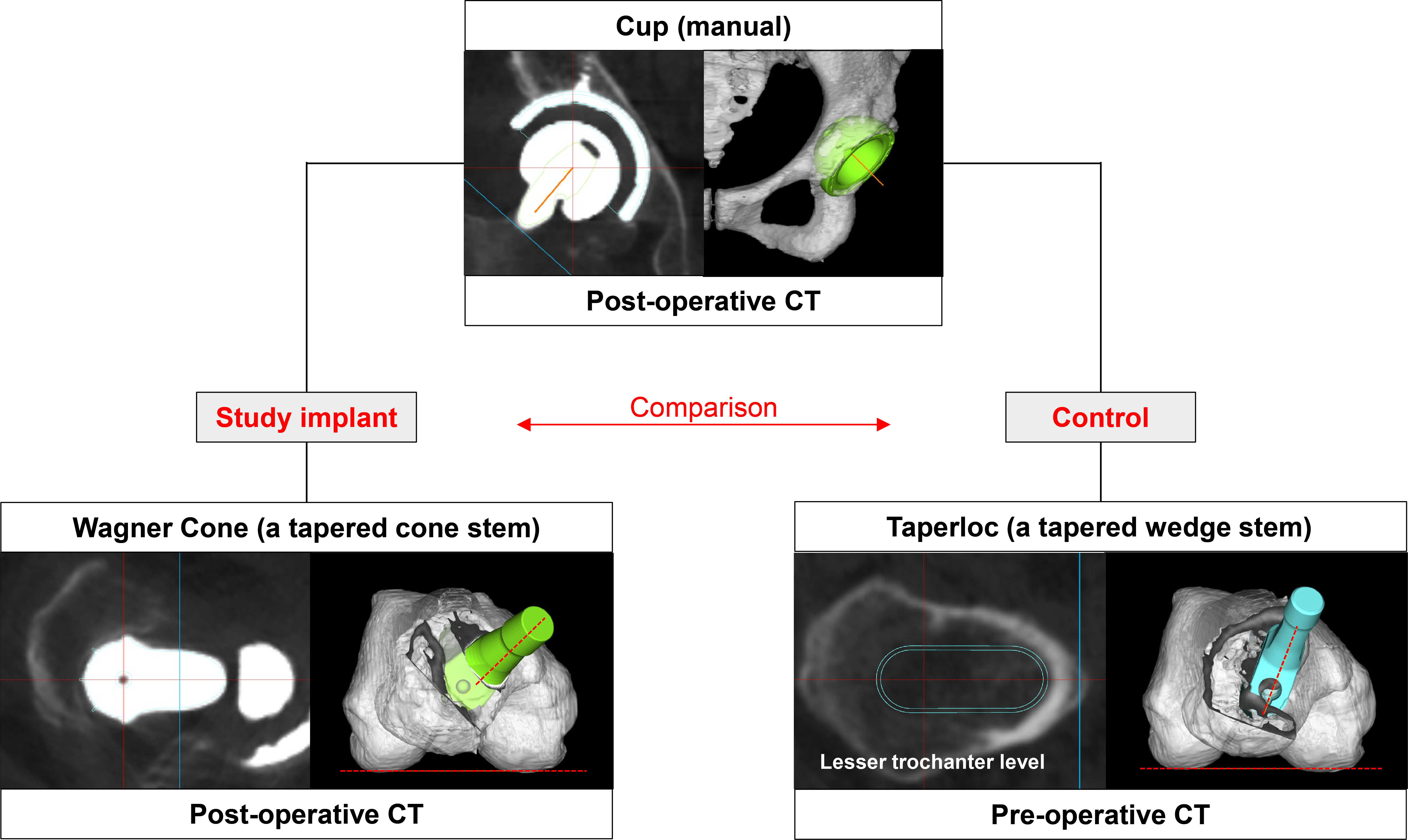 Fig. 3 
            As a control in the simulation, the Taperloc (Taperloc Complete; Zimmer Biomet, USA) was virtually installed in the most congruent position, with the medullary cavity at the centre level of the lesser trochanter, and ensuring that the entire 3D computer-aided design (CAD) models of the stem fitted within the medullary cavity according to the bone morphology.
          