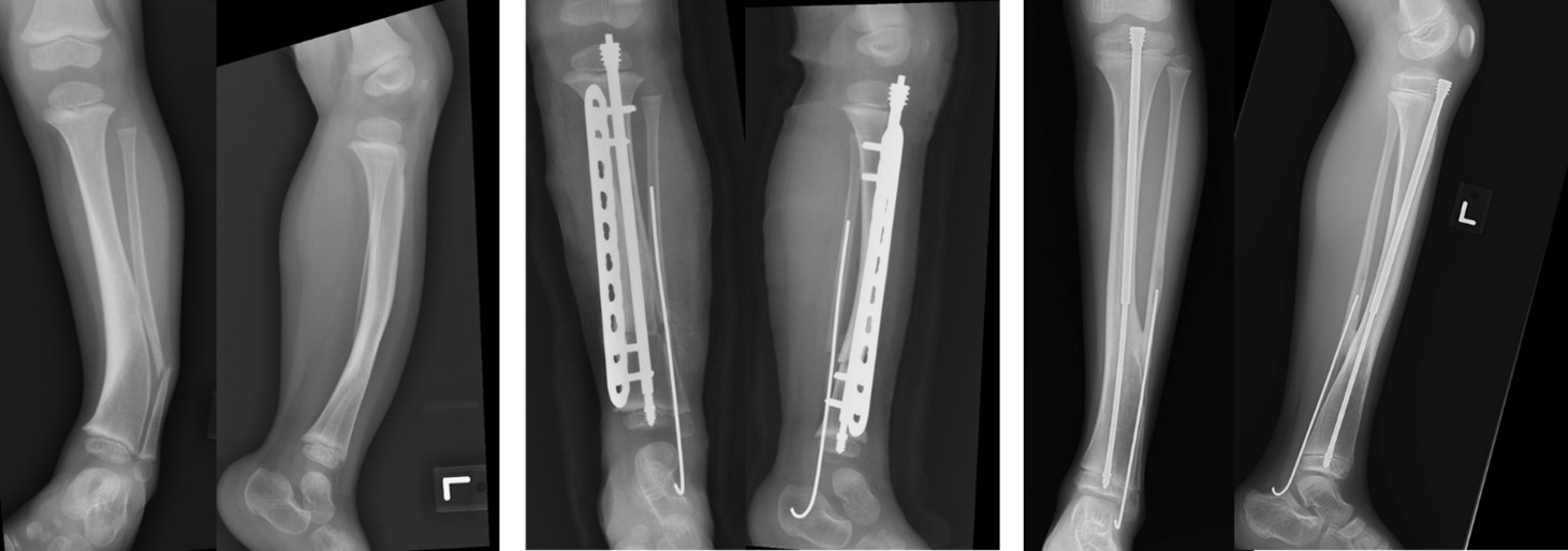 Fig. 1 
          Serial radiographs in the anteroposterior and lateral views of a two-year-old female patient in Group 1 who underwent excision of hamartoma, cross-union of the tibia and fibula, autogenic iliac bone grafting, and internal fixation. a) Initial radiographs of the patient, who was diagnosed with congenital pseudarthrosis of the tibia. b) Radiographs following surgical excision of hamartoma, cross-union of the tibia and fibula, autogenic iliac bone grafting, and internal fixation. c) Radiographs at latest follow-up of the patient at seven years old demonstrating good cross-union, with the fixation plate removed due to implant prominence.
        