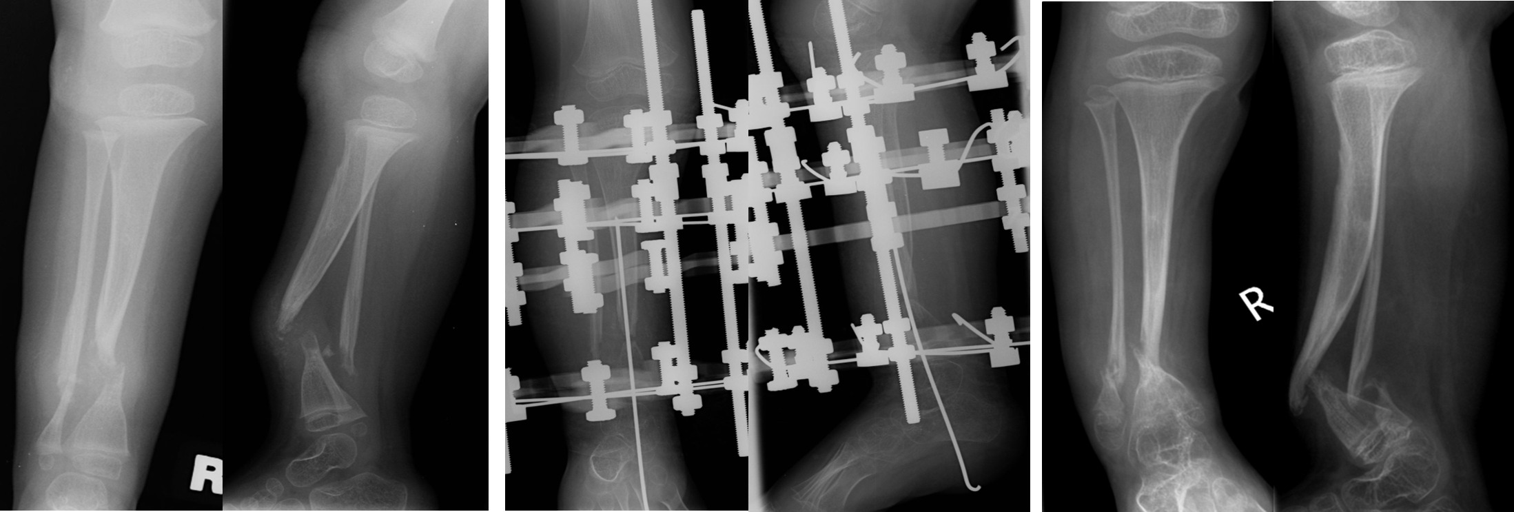 Fig. 2 
          Serial radiographs in the anteroposterior and lateral views of a two-year-old male patient in Group 2 who underwent excision of harmatoma, intramedullary rodding, and external fixation without cross-union. a) Initial radiographs of the patient, who was diagnosed with congenital pseudarthrosis of the tibia. b) Radiographs following surgical excision of harmatoma, intramedullary rodding, and external fixation without cross-union. c) Radiographs at follow-up demonstrating persistent nonunion, requiring multiple subsequent surgical procedures.
        