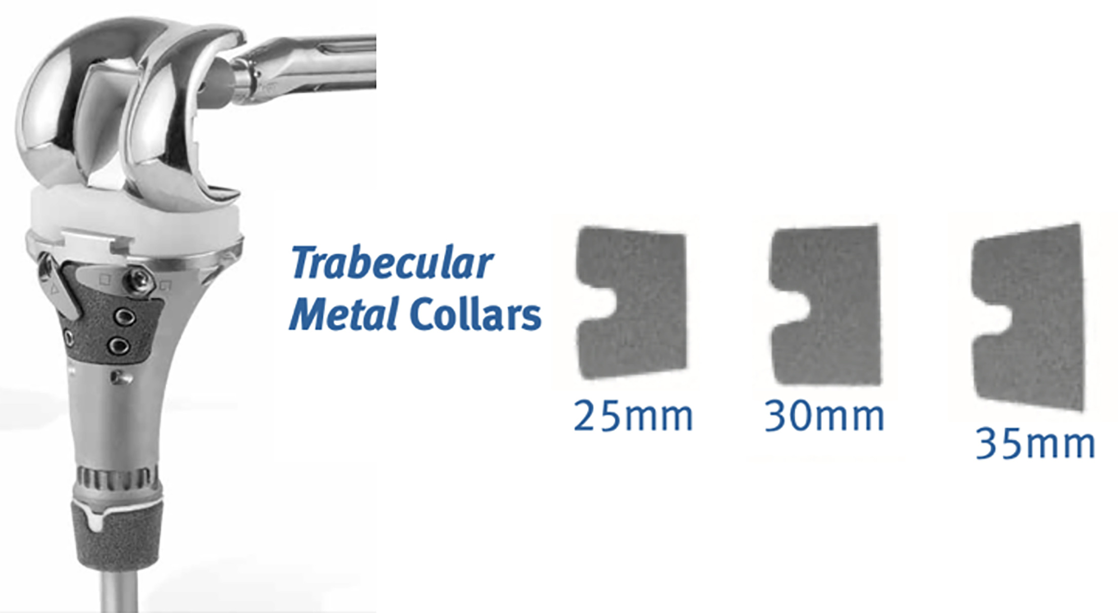 Fig. 1 
          Zimmer Segmental proximal tibial replacement and associated trabecular metal collars.
        