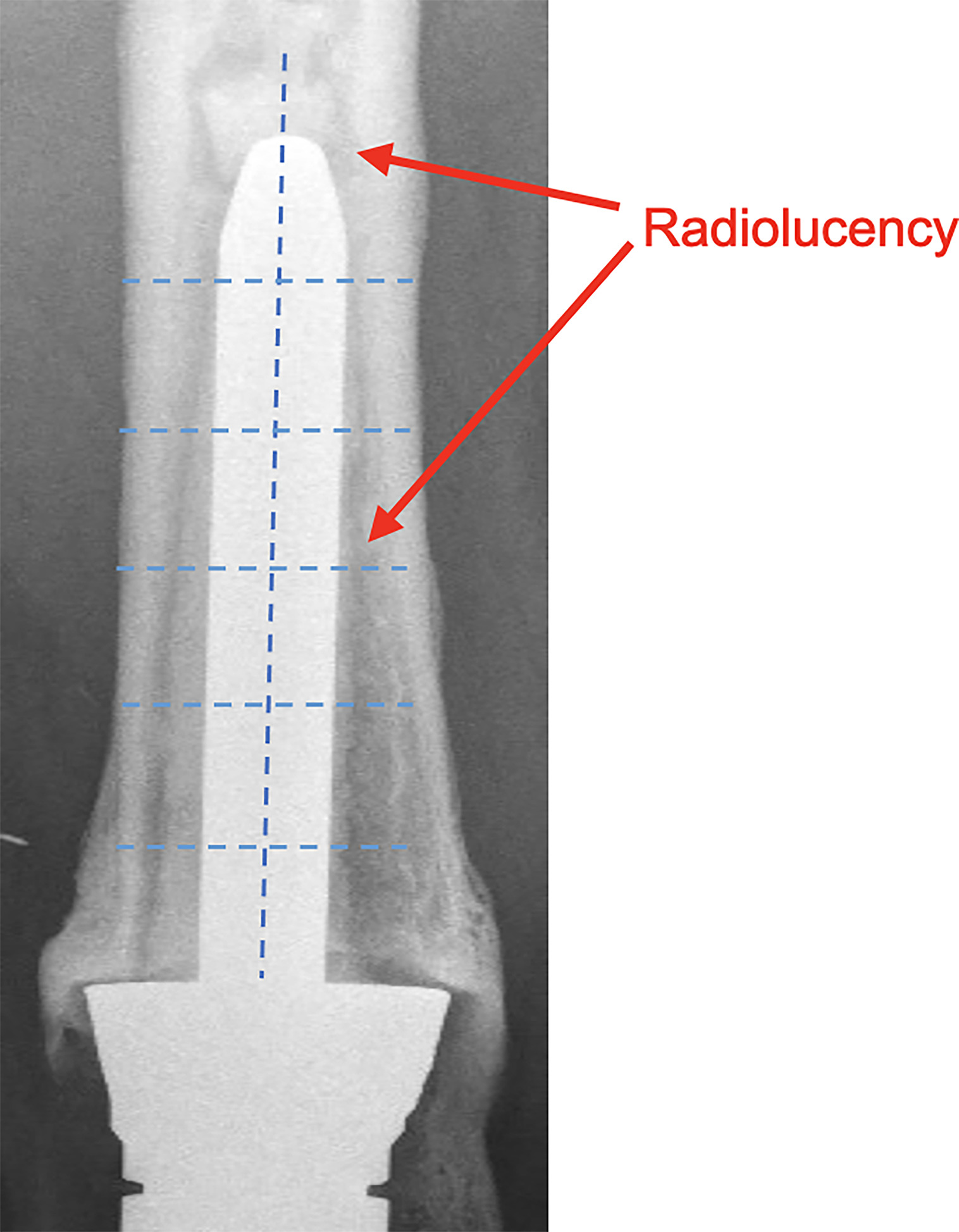 Fig. 3 
            Radiolucent line score: cemented intramedullary fixation.
          