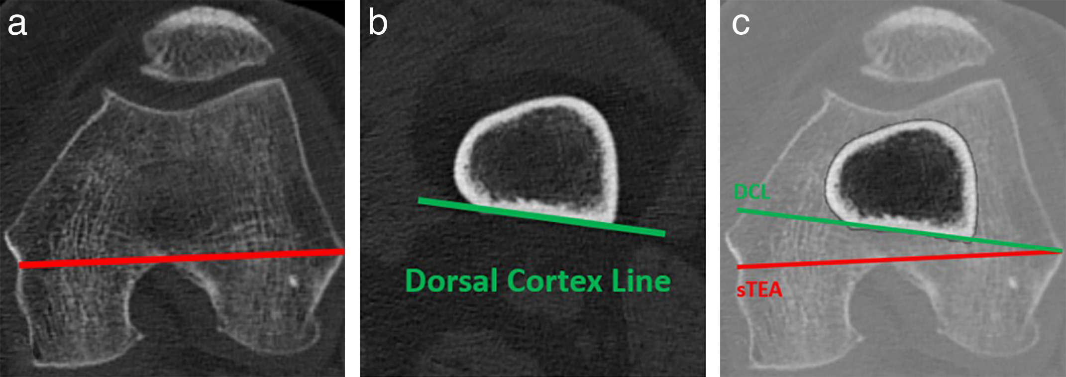 Fig. 1 
          a) Surgical transepicondylar axis in a coronal CT plane; b) dorsal cortex line measured 75 mm above the joint line in coronal plane; and c) an example of overlap between surgical transepicondylar axis and dorsal cortex line.
        