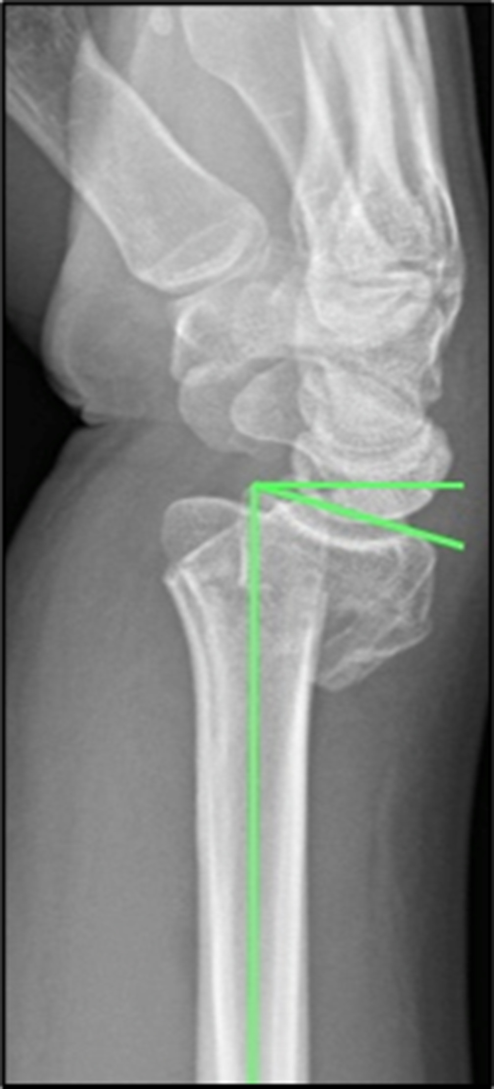 Fig. 1 
            Radial angulation: the angle between the articular surface of the radius and the perpendicular of the long axis of the radius measured on the lateral radiograph.
          