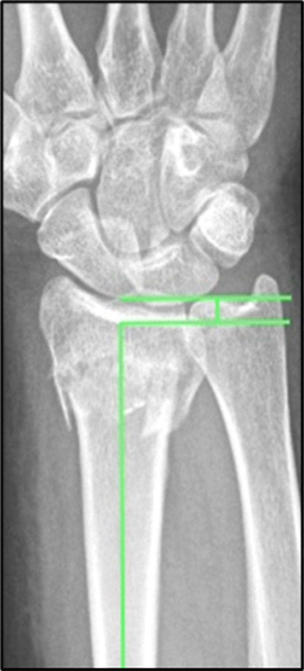 Fig. 2 
            Radial shortening: the distance between the radial and ulnar articular surfaces measured on the posteroanterior radiograph.
          