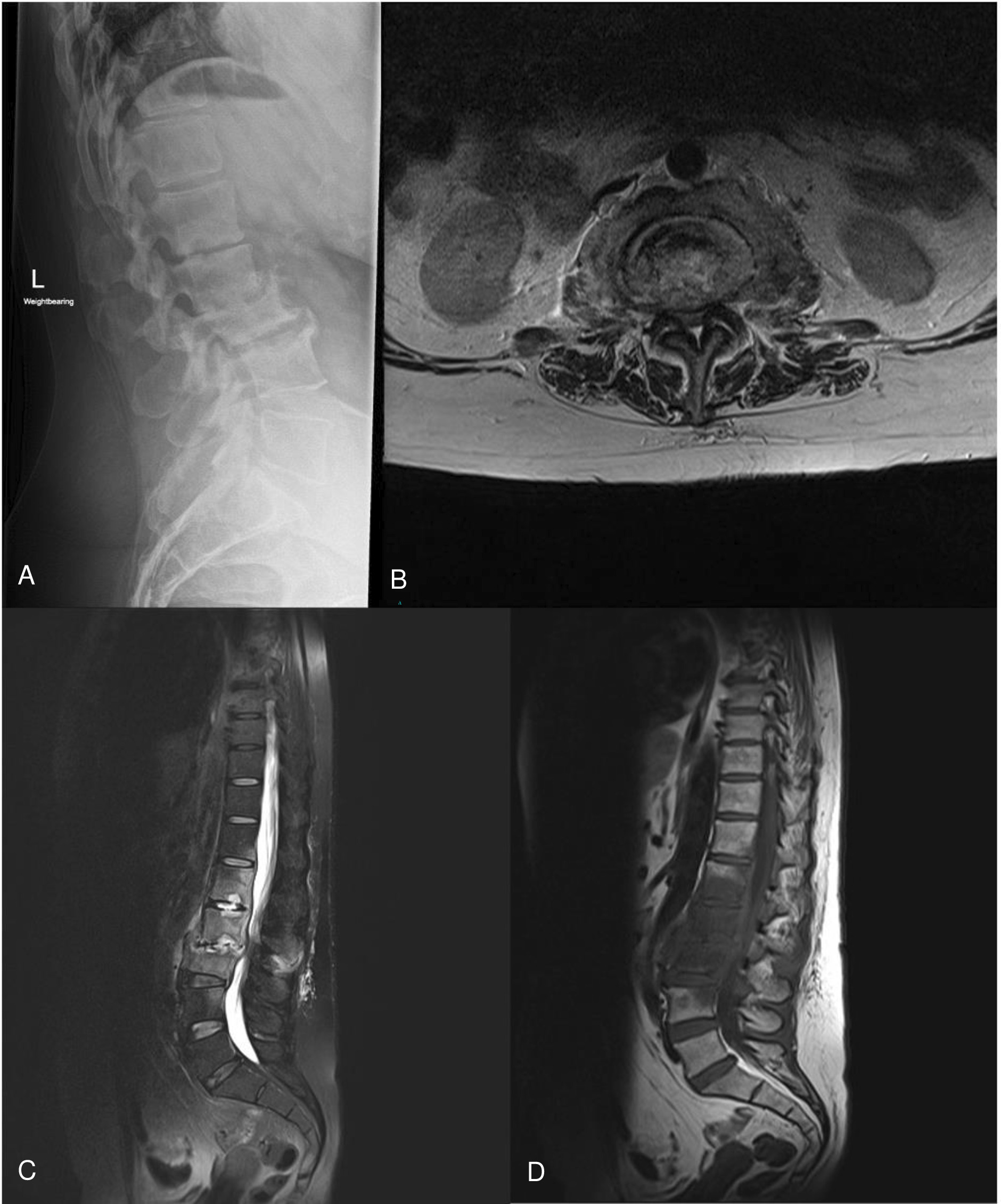 Fig. 2 
            a) Lateral lumbar spine radiograph showing L2/3 discitis with L2/3 disc space destruction, less than 50% destruction of L3 and mild inferior endplate of L2 destruction. There is mild endplate destruction at L3/4. b) Axial T2 image shows epidural and paraspinal abscesses. c) to d) Inflammatory tissue in the paraspinal region. Inflammation in the right psoas, which can progress to a psoas abscess. T2 and T1 sagittal MRI imaging shows disc space destruction and fluid collections such as epidural abscess. d) T1 imaging shows the true extent of the vertebral body involvement extending up into L1 and down into L4.
          