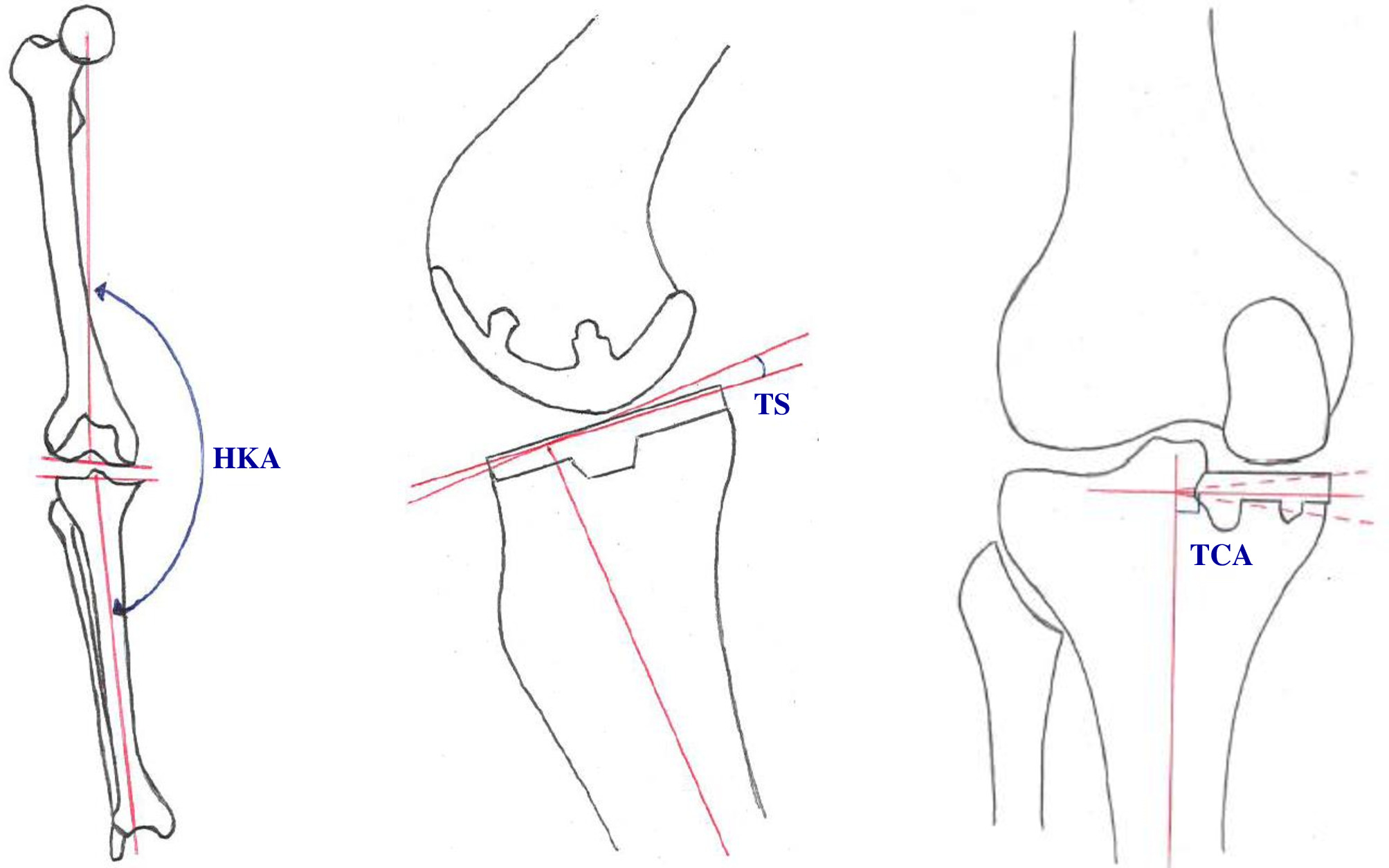 Fig. 2 
            Illustration of radiological outcomes: hip-knee-ankle angle (HKA; left), tibial slope (TS; centre), and tibial coronal alignment angle (TCA; right).
          