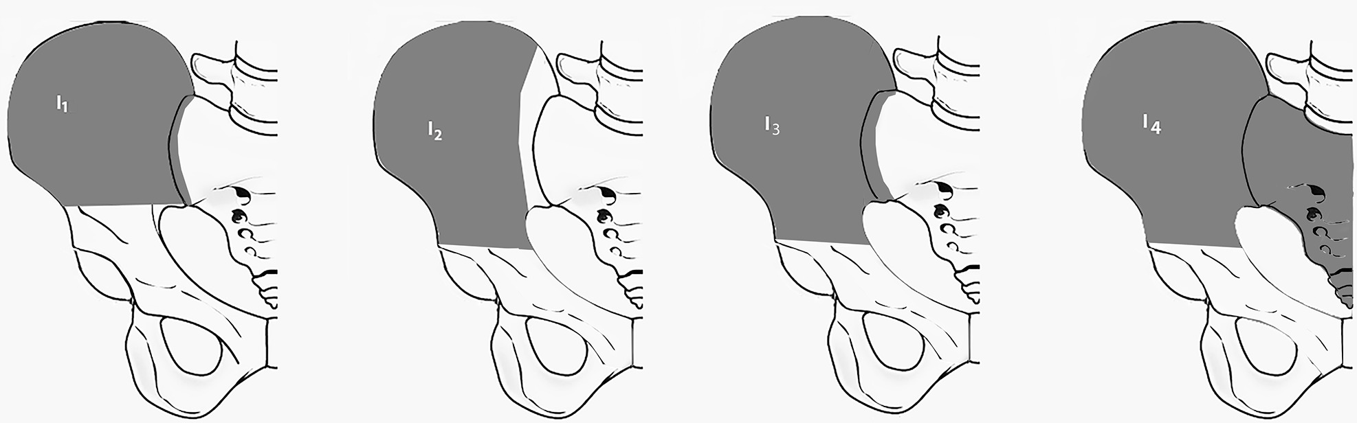 Fig. 2 
          Pictorial image of the modified Campanacci classification for iliac resections.
        
