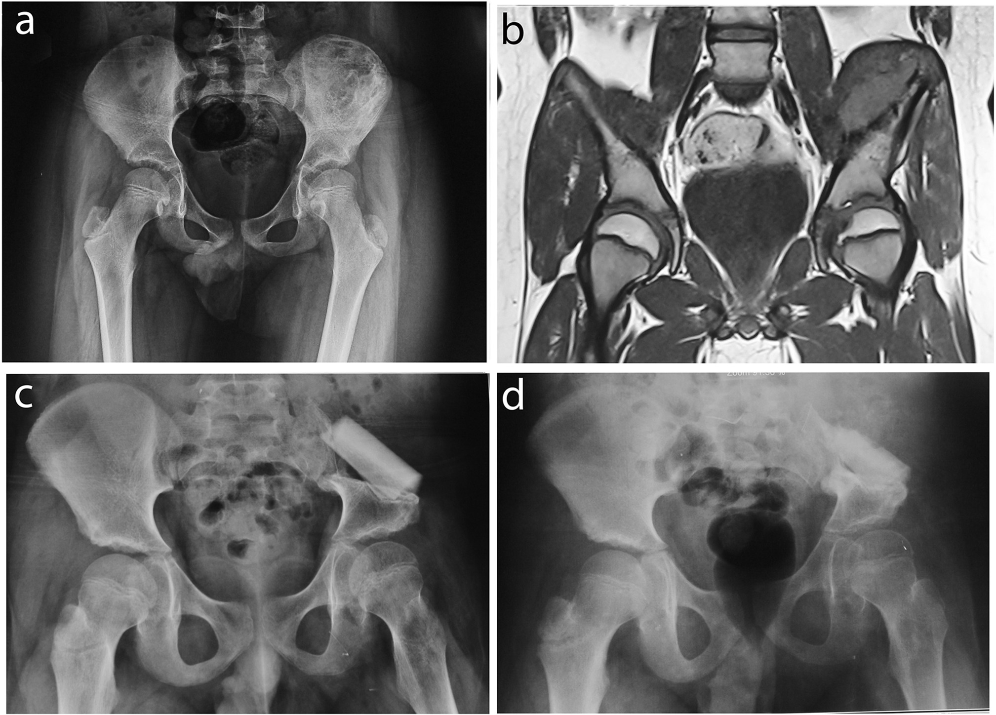 Fig. 3 
            a) Anteroposterior radiograph of the hip showing post-chemotherapy Ewing’s sarcoma of the ilium in a ten-year-old male. b) T1-weighted MRI of the hip showing the intact sciatic notch (Zone I1 resection). c) Anteroposterior radiograph of the hip three months after surgical resection and reconstruction with tibial strut graft. d) Anteroposterior radiograph of the hip five years after surgical resection and reconstruction, showing a limb shortening of 2 cm.
          